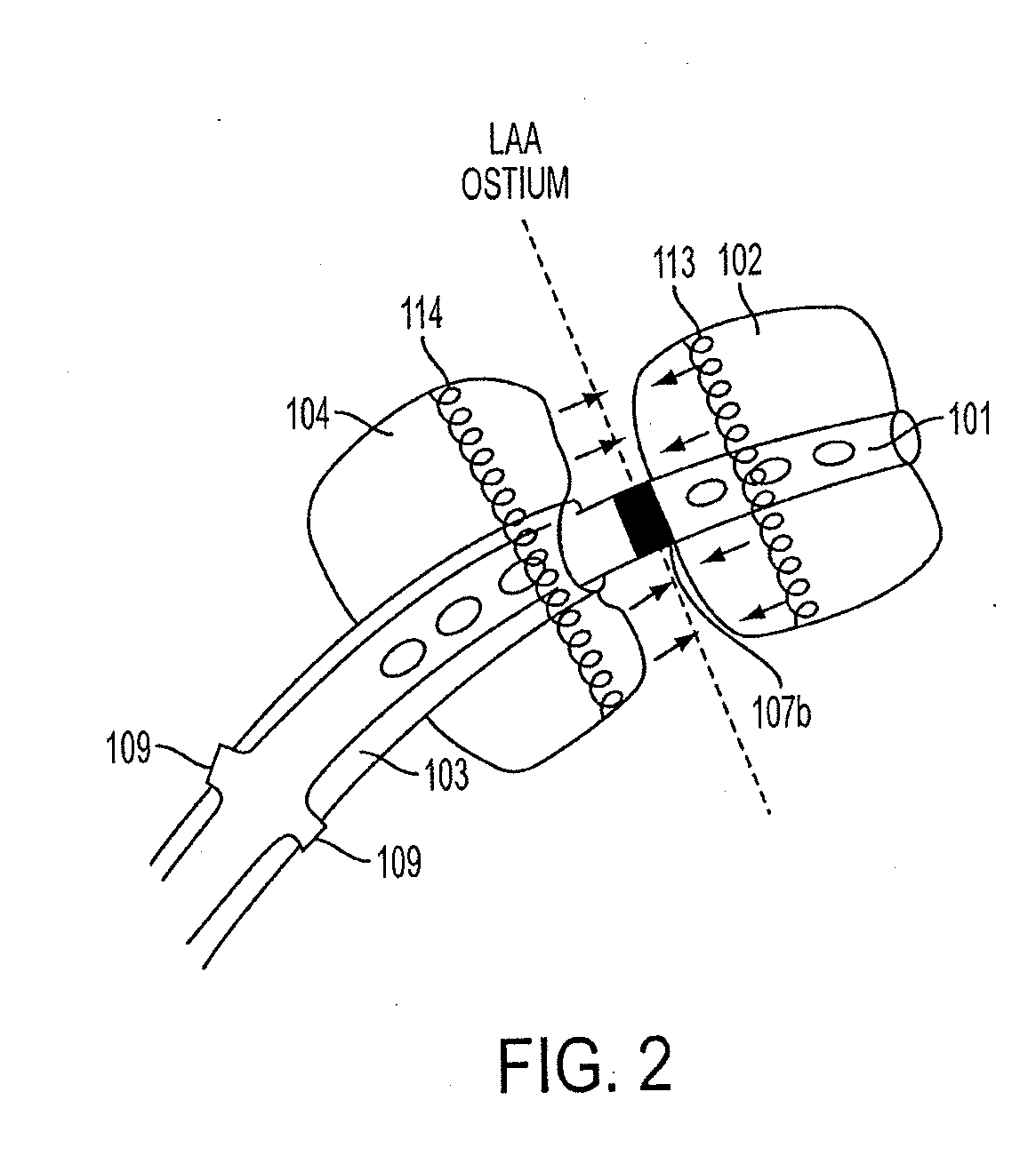 Methods and systems for preventing bleeding from the left atrial appendage