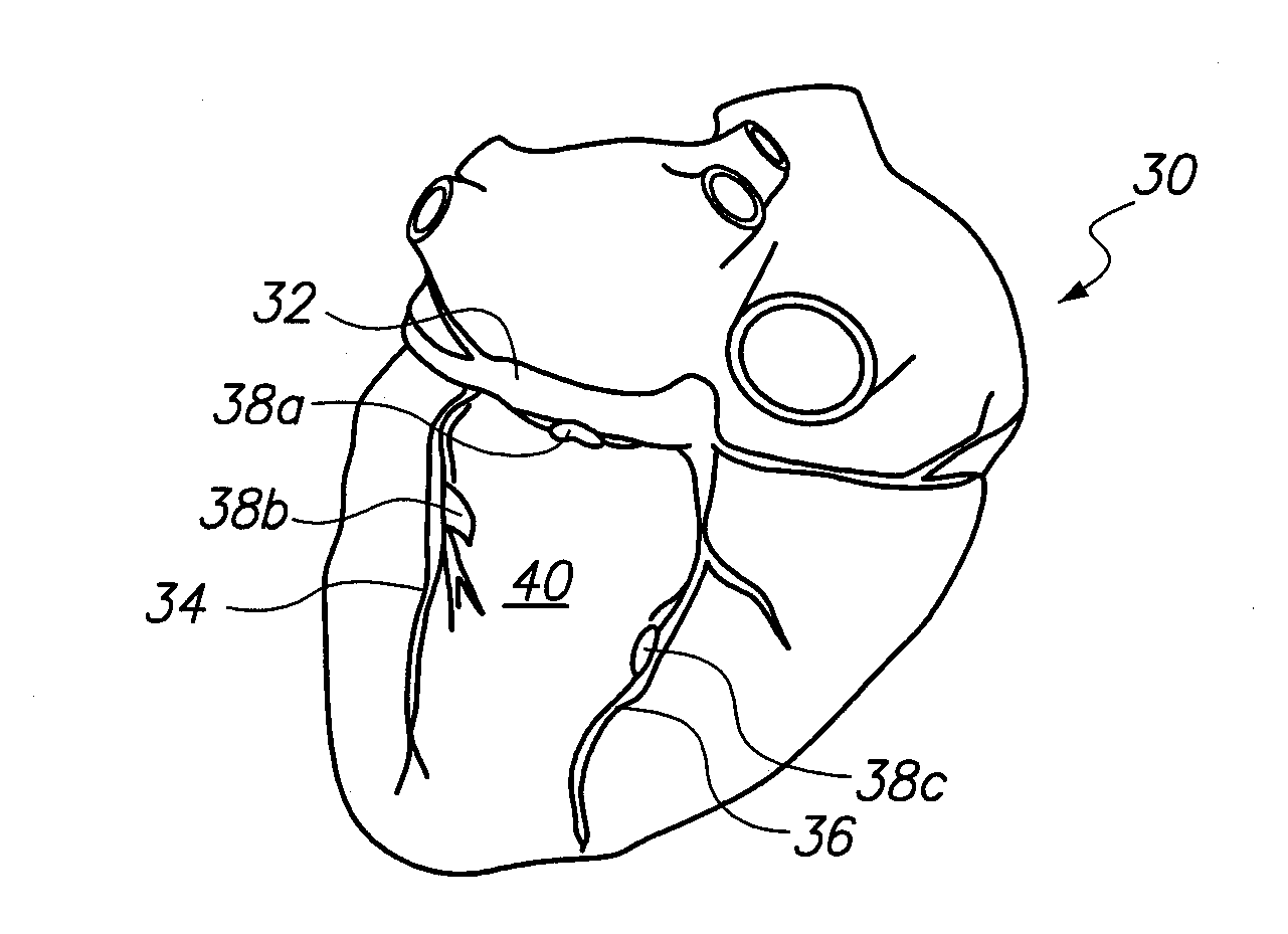 System and Method for Transvascular Activation of Cardiac Nerves with Automatic Restart