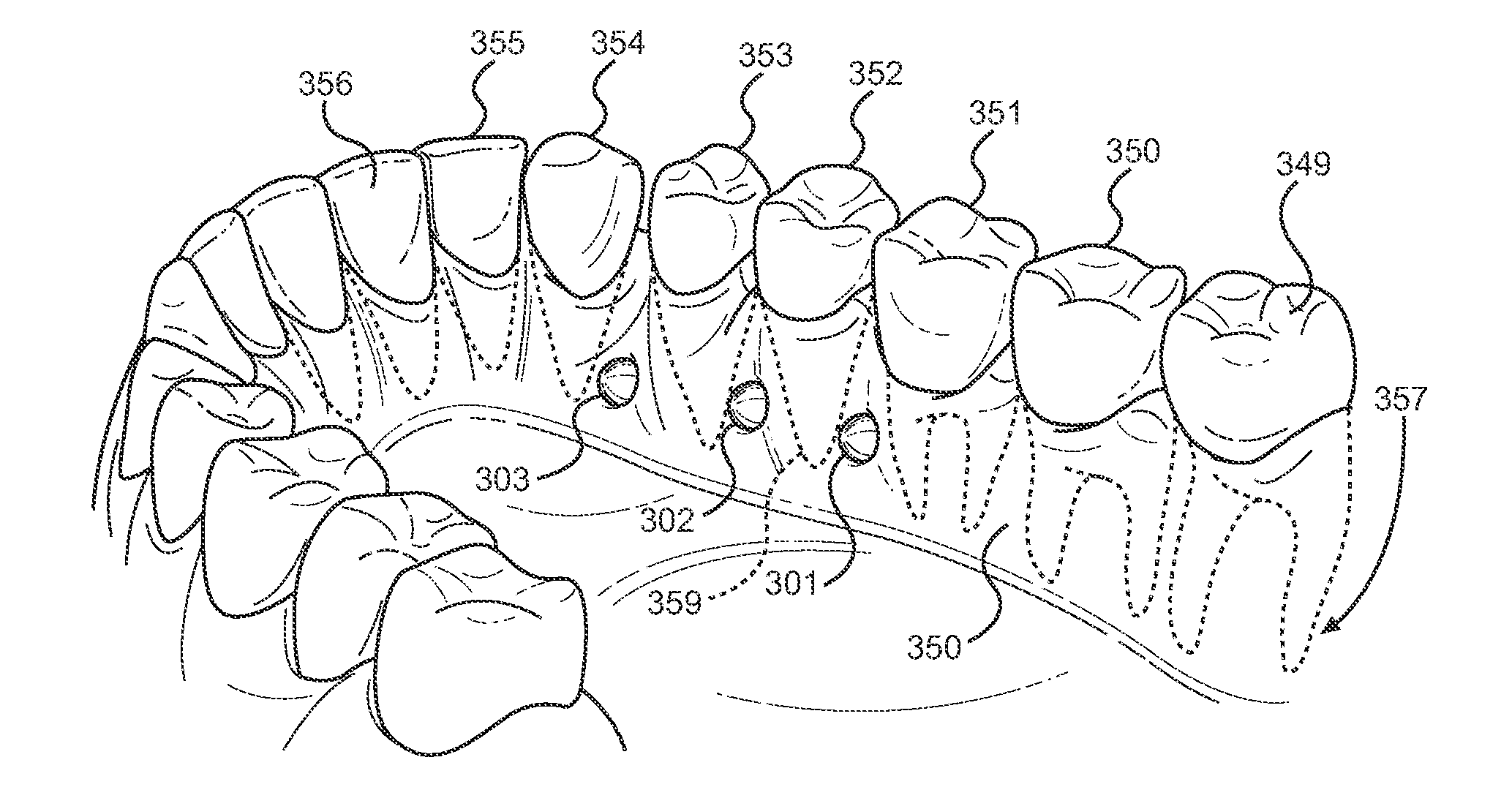 System and Method of Installing Dental Prostheses for Passively Influencing Tongue Position to Reduce Airway Obstruction