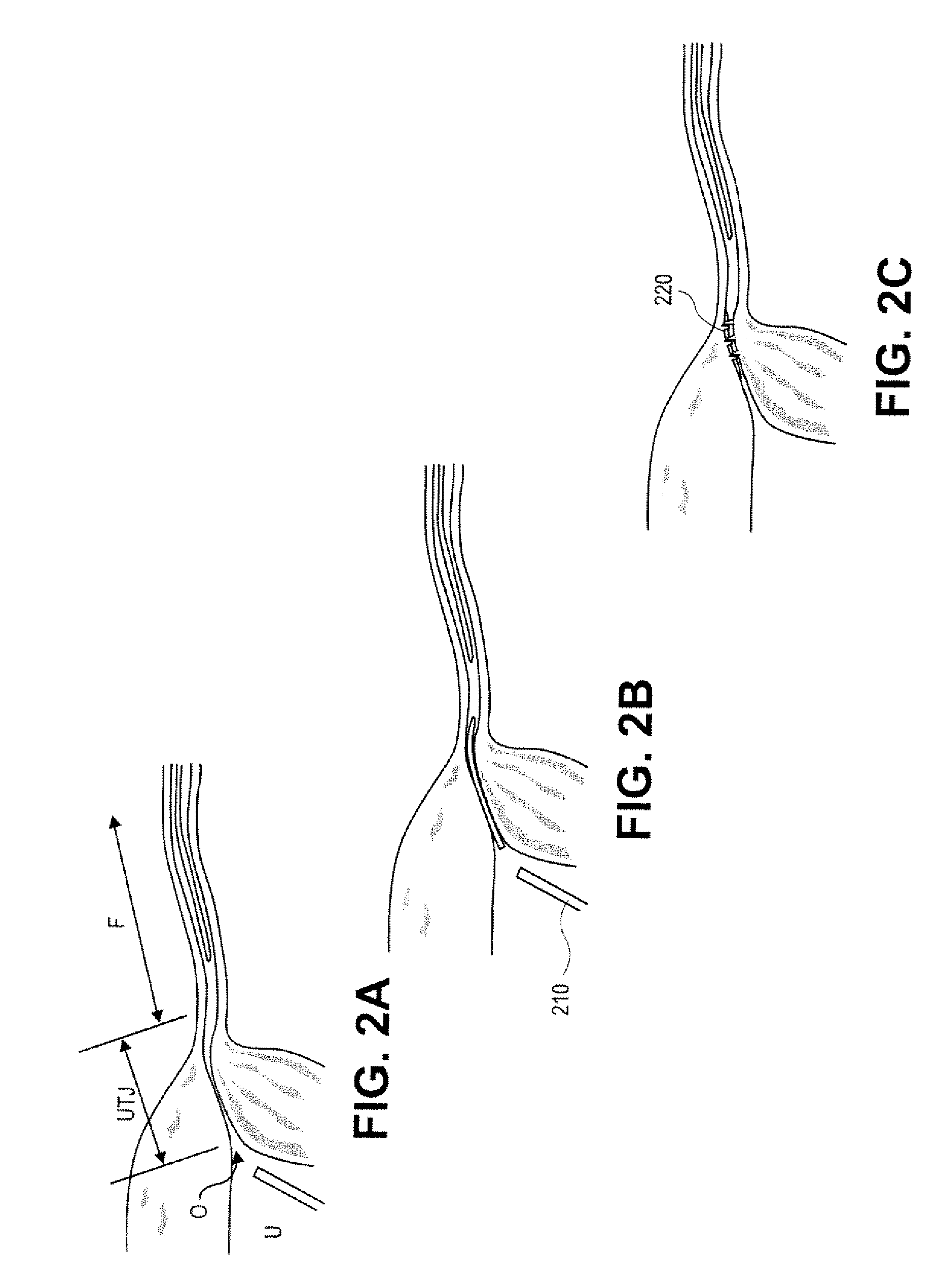Devices and methods for occluding a fallopian tube