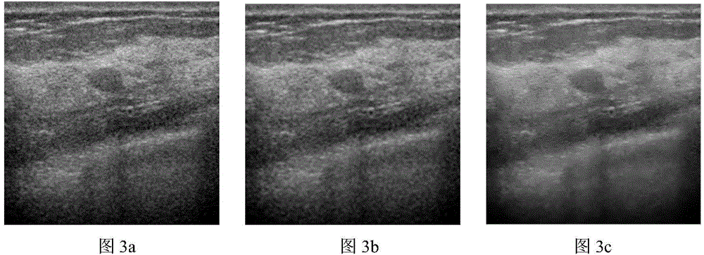 Medical ultrasound image noise reduction method based on thresholding improved wavelet transform and guide filter