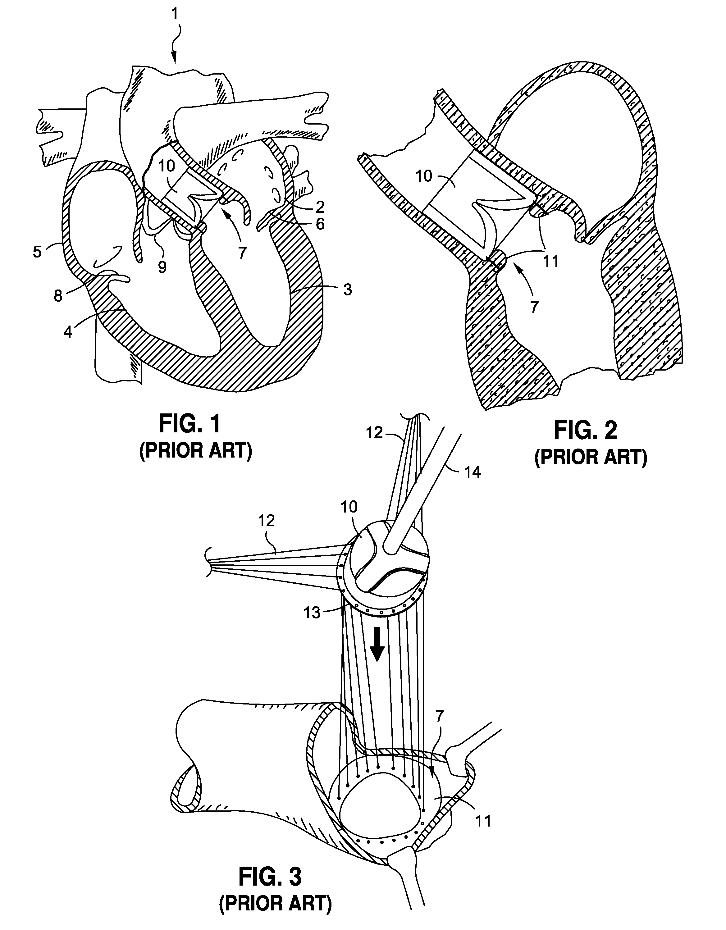 Heart valve prosthesis anchoring device and methods
