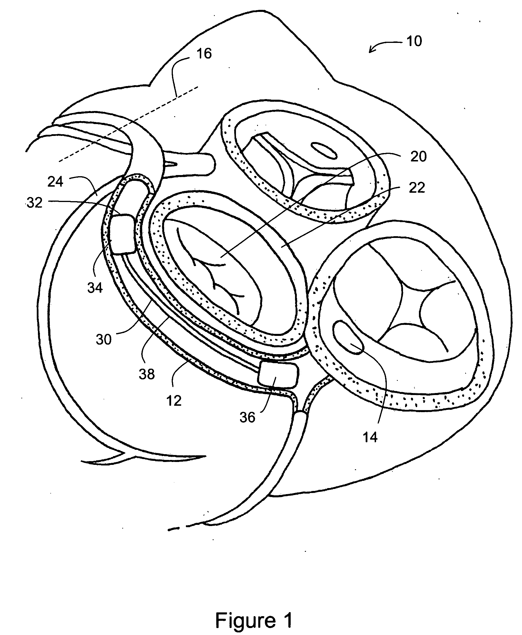 Tissue shaping device with self-expanding anchors