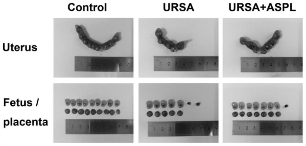 Application of aspirin in preparation of medicine for preventing and treating unexplained recurrent abortion