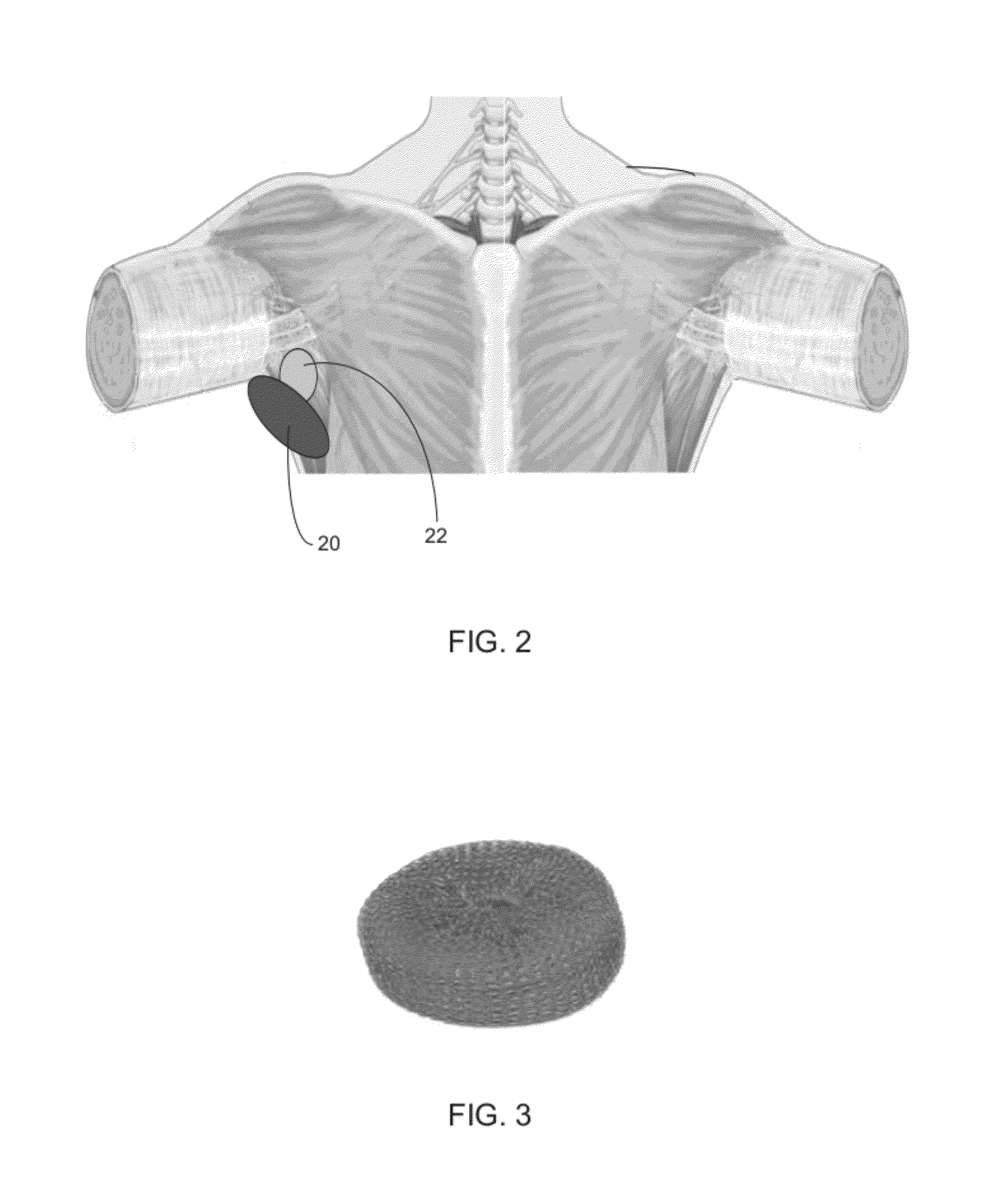 Apparatus and methods for controlling bleeding using externally applied pressure