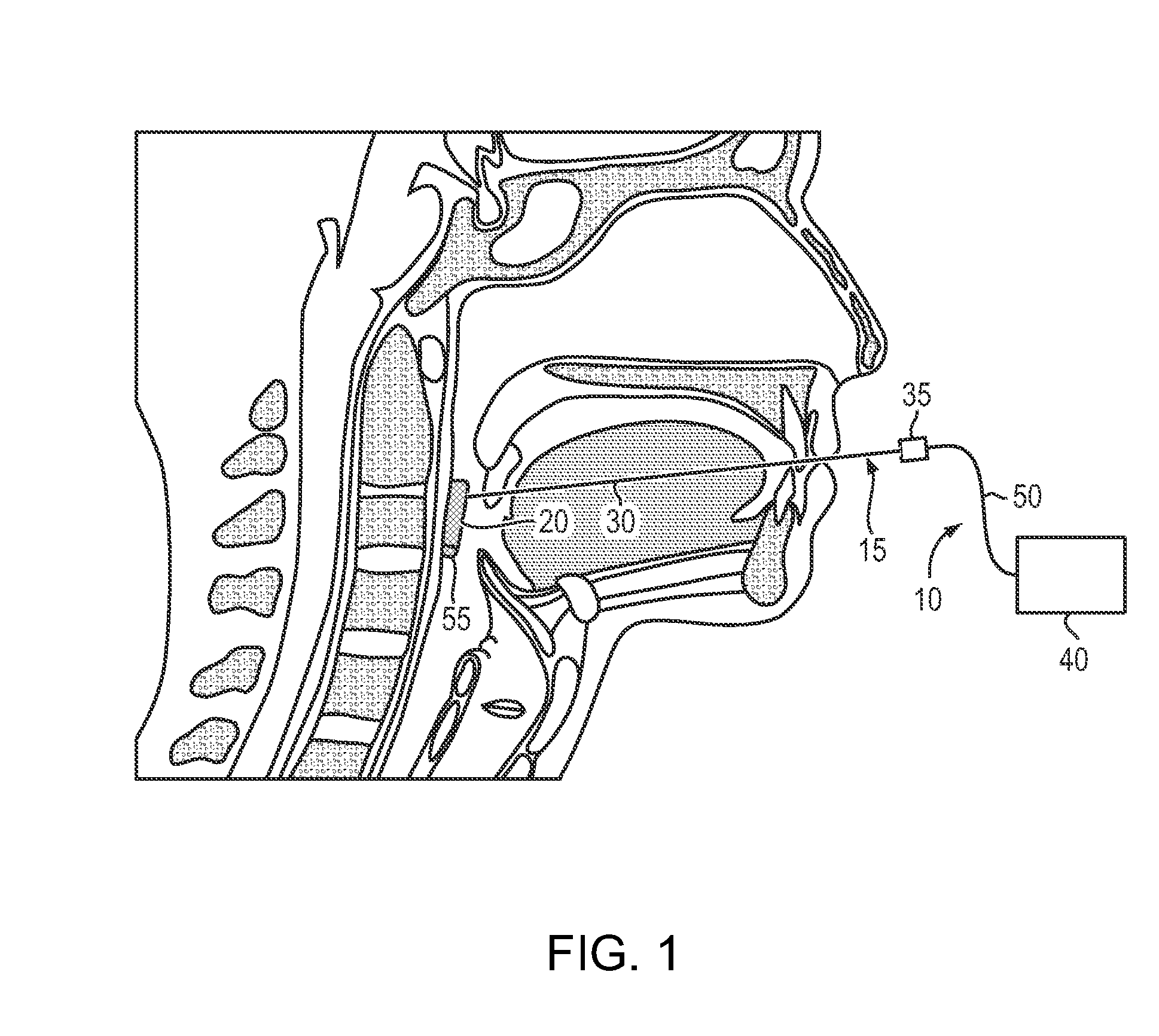 Apparatus and methods for treatment of obstructive sleep apnea utilizing cryolysis of adipose tissues