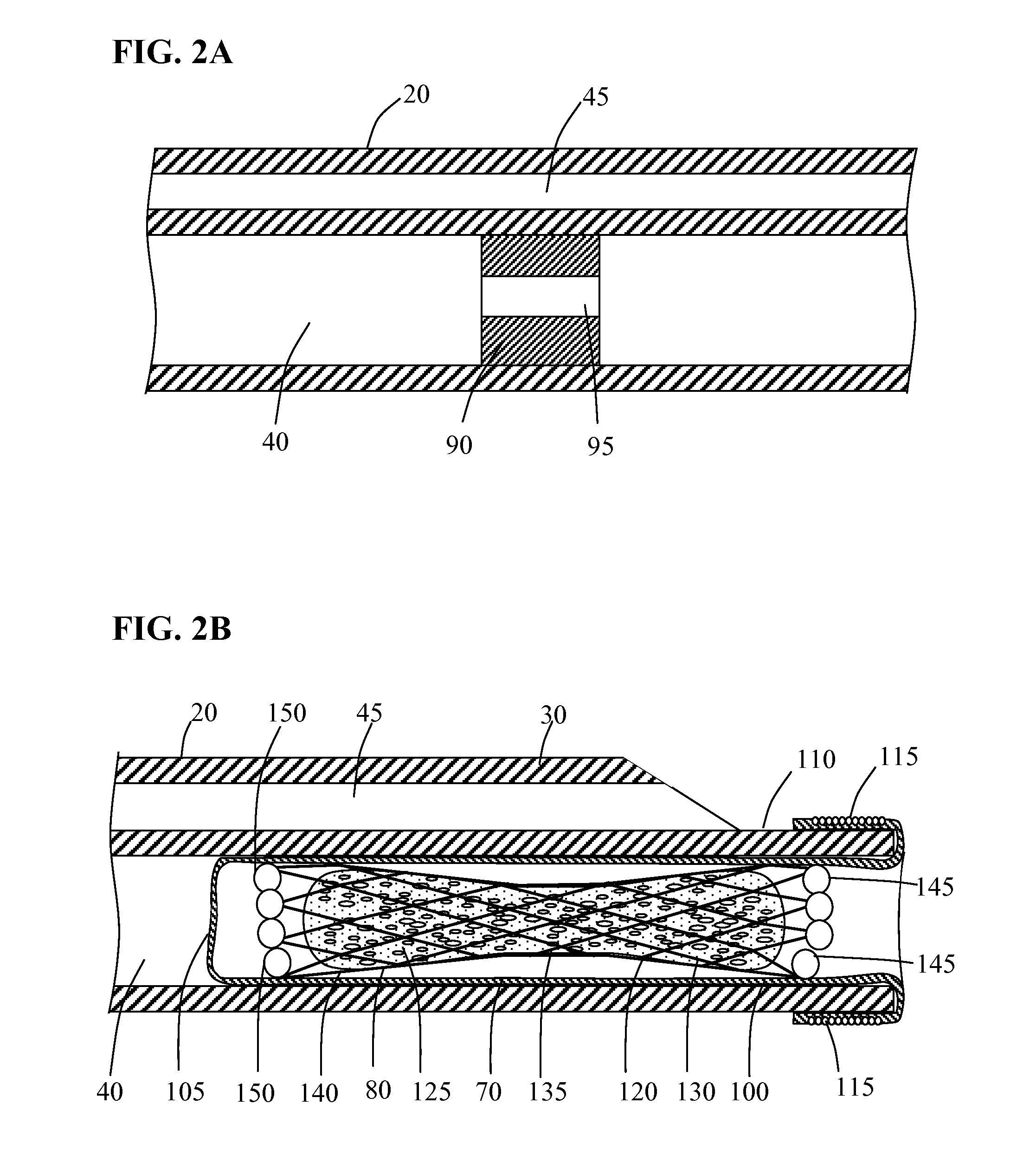 Systems and devices for intralumenal implantation