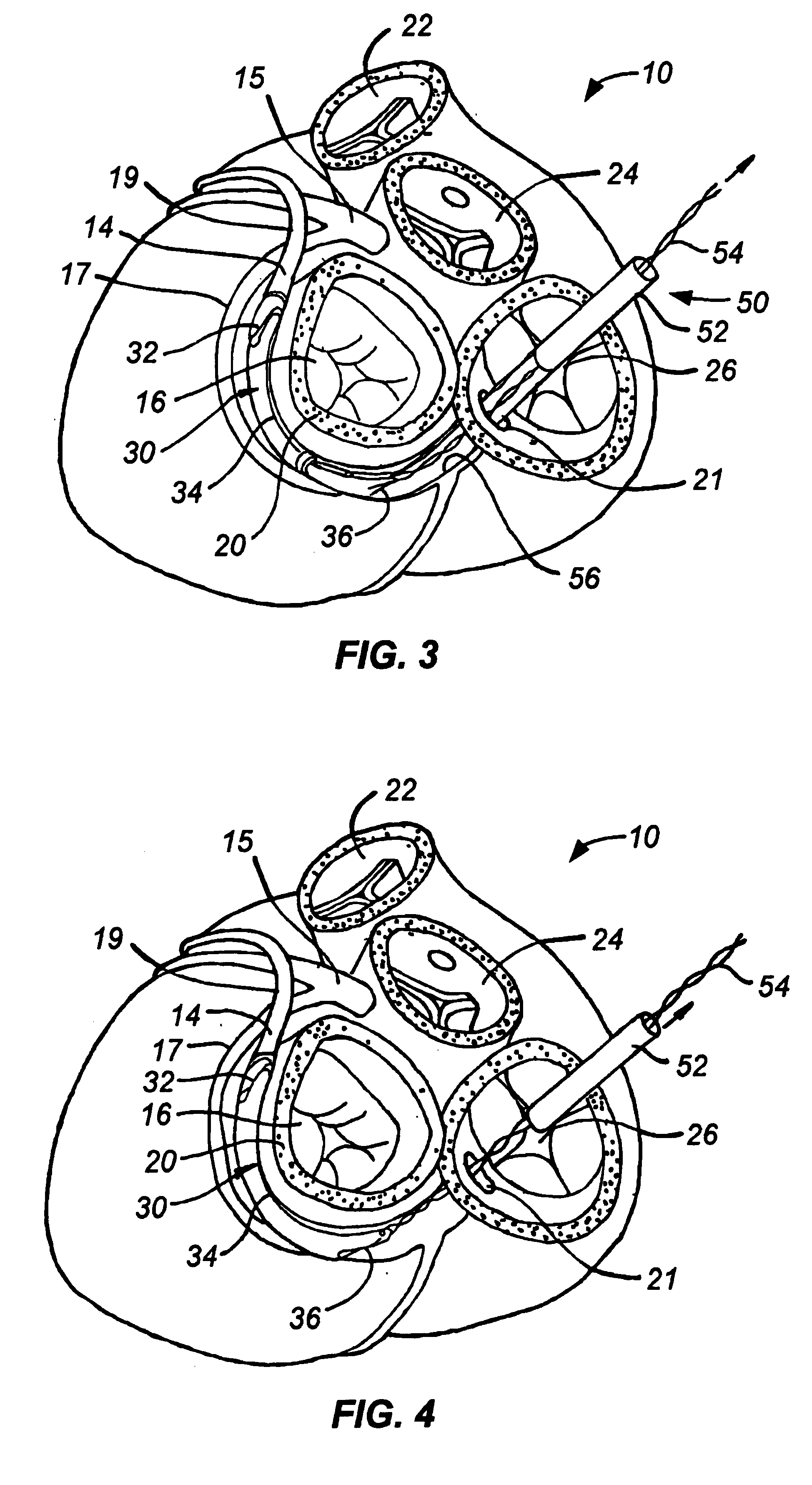 Fixed length anchor and pull mitral valve device and method