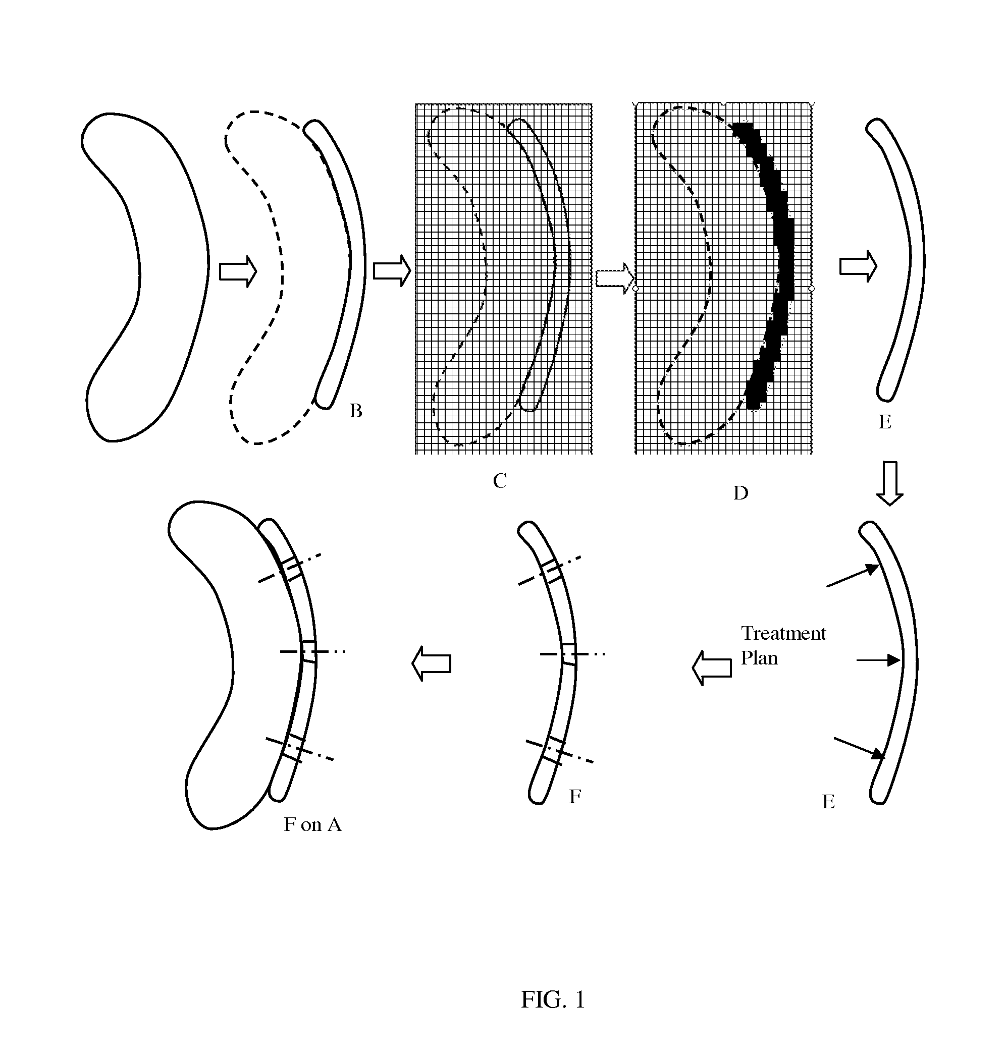 Design method of surgical scan templates and improved treatment planning