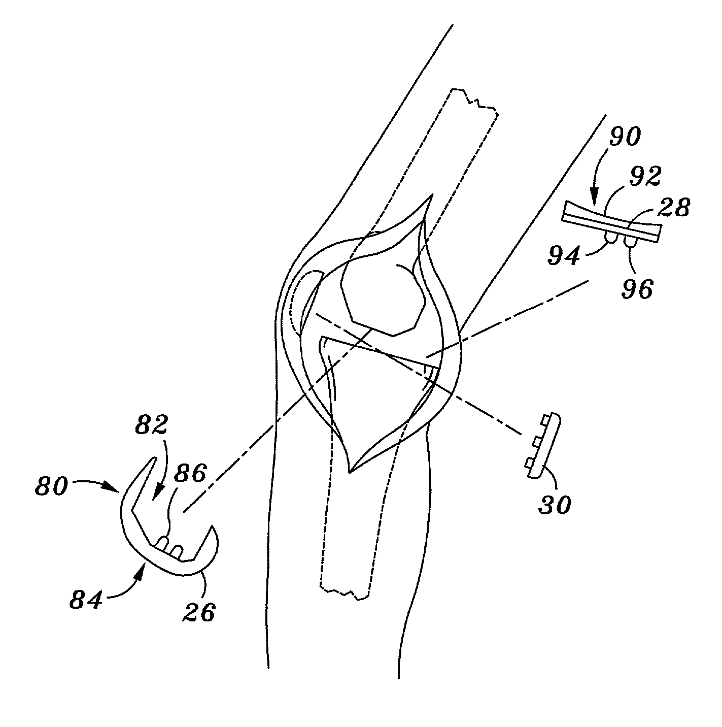 Method and apparatus for minimally invasive knee arthroplasty