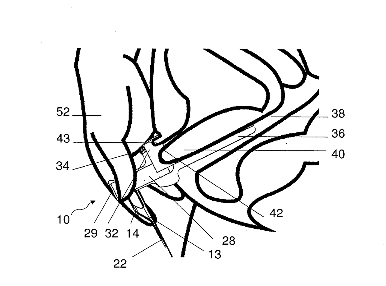 A method and device for external urinary incontinence treatment for women