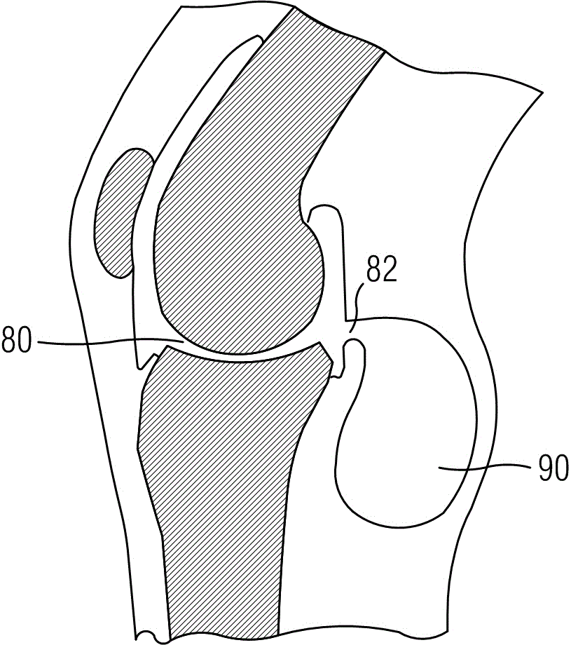 Knee-joint cavity implant for treating popliteal cyst