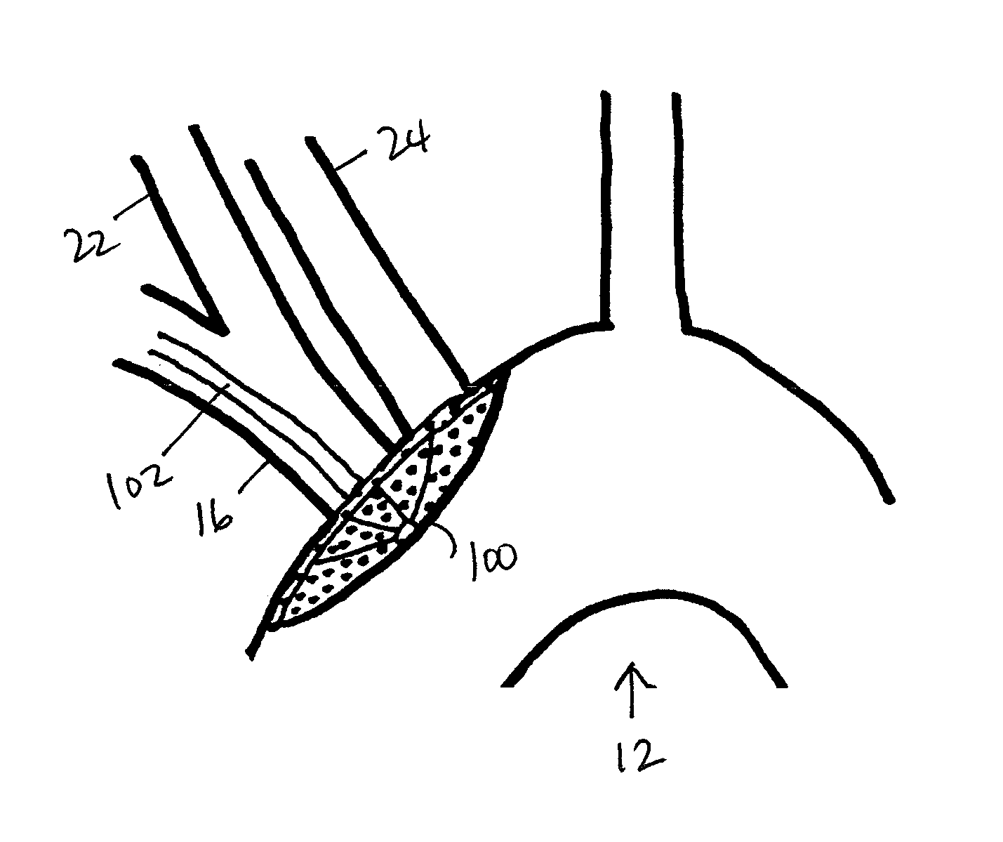 Method of deflecting emboli from the cerebral circulation