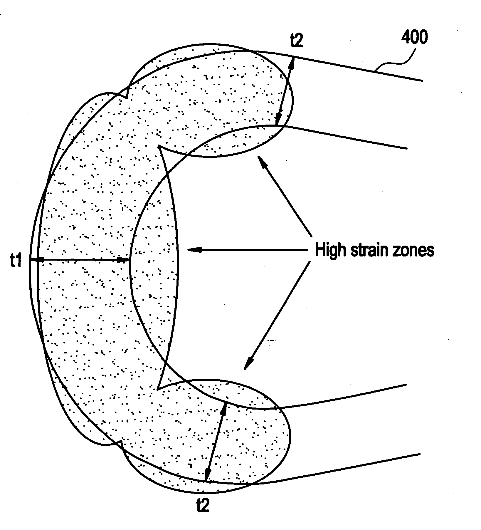 Polymeric stent having modified molecular structures in selected regions of the hoops and method for increasing elongation at break