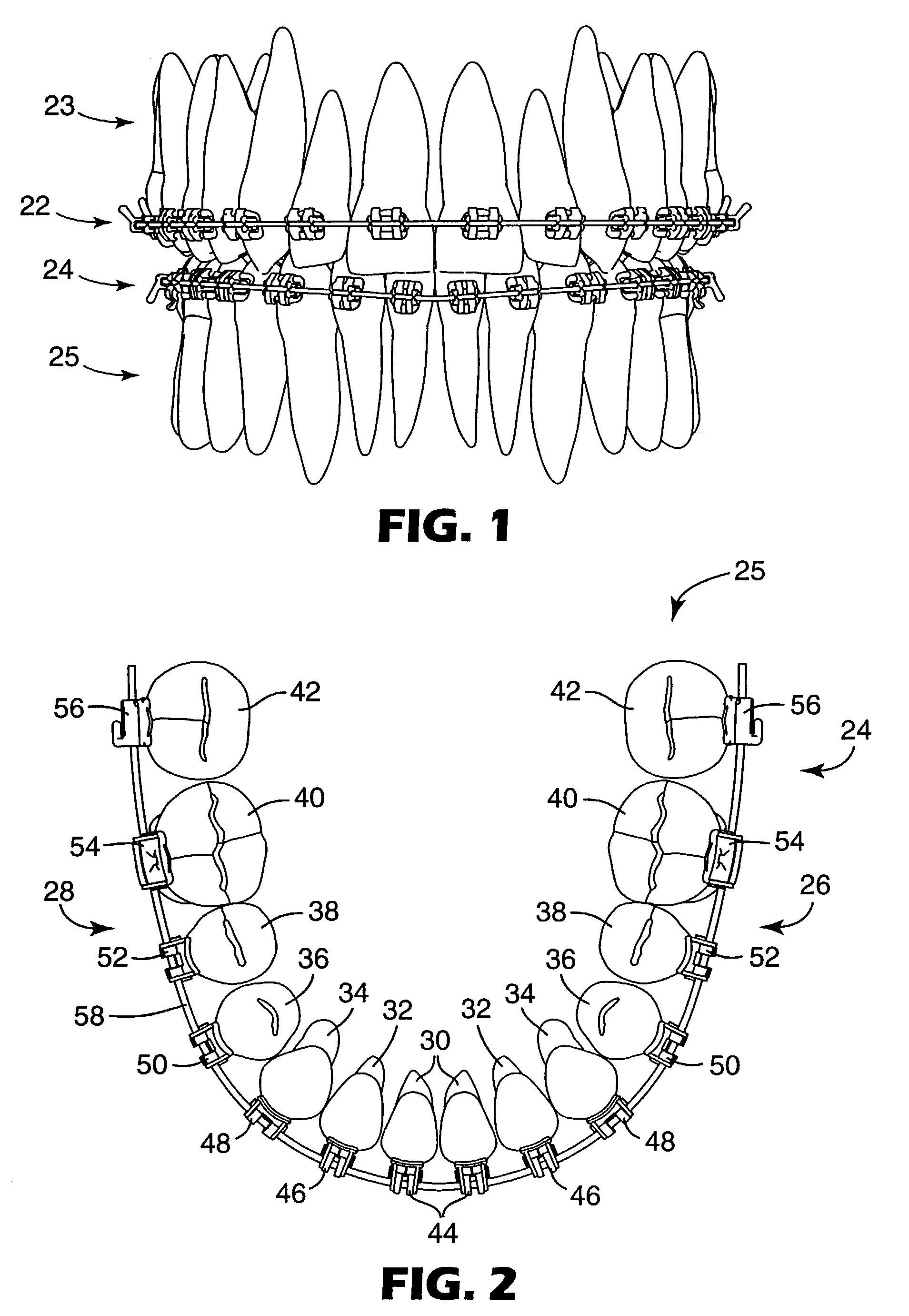 Orthodontic brace with self-releasing appliances