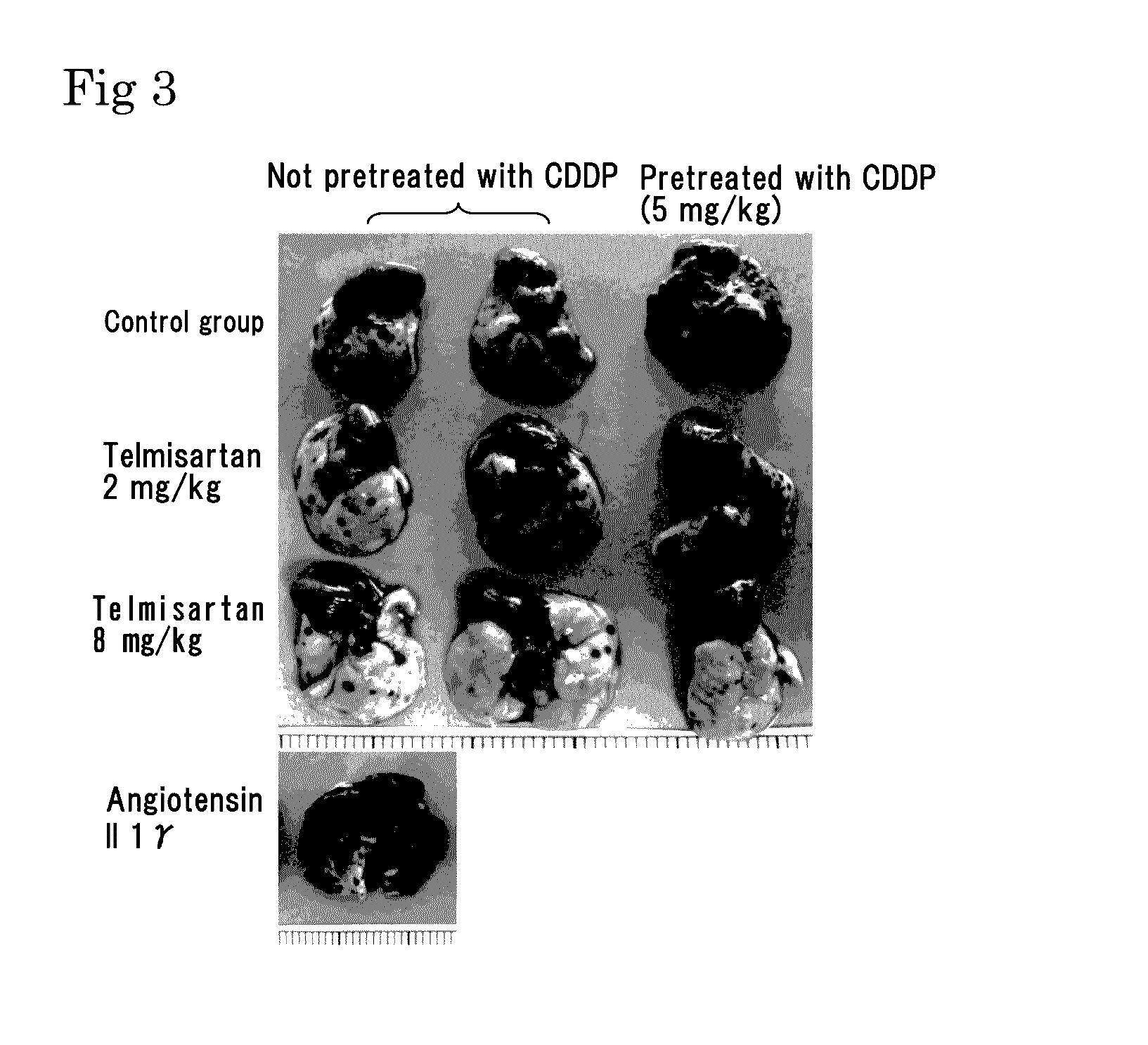 Medicinal agent for suppressing malignant tumor metastasis