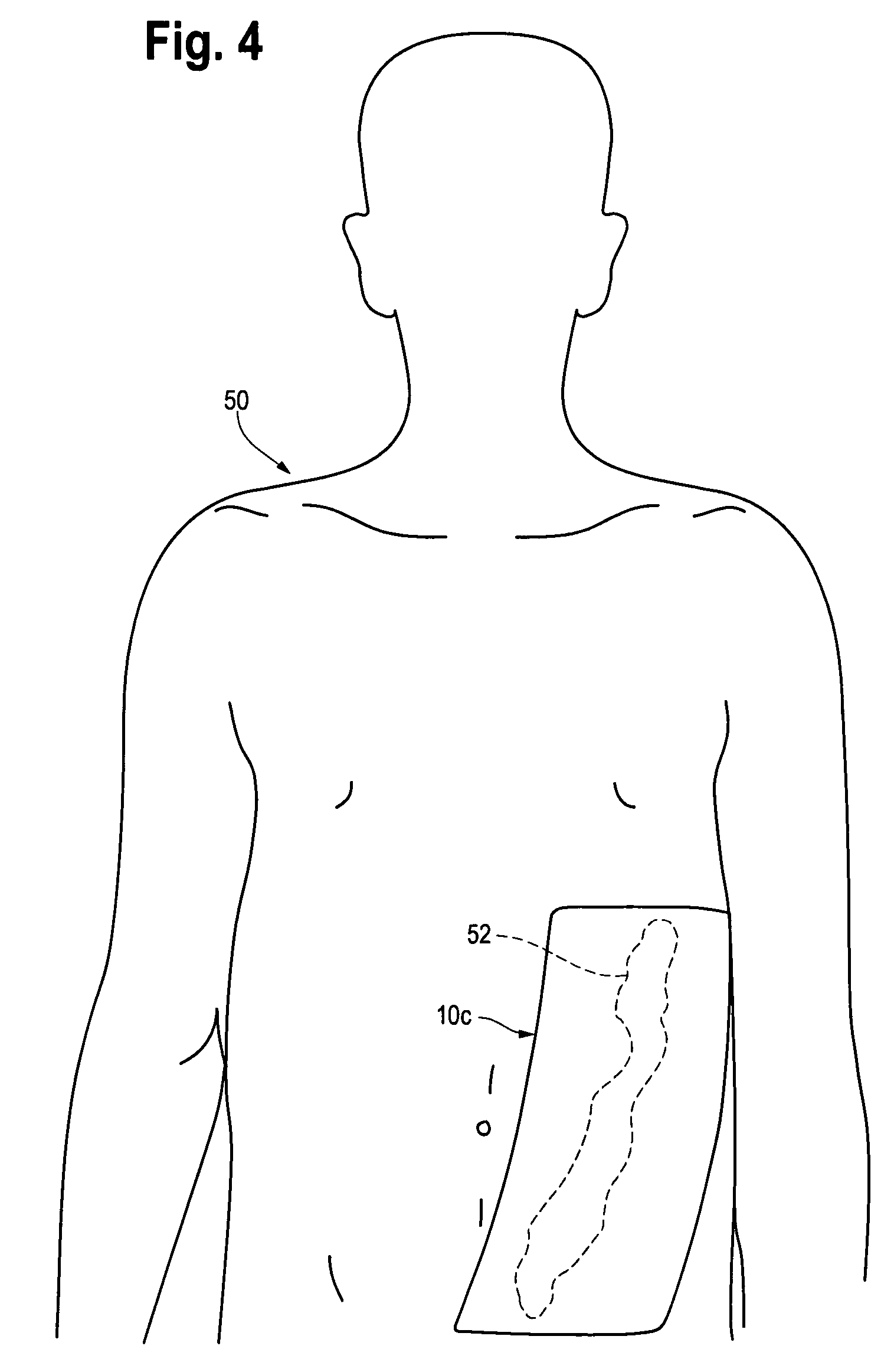 Injection and hemostasis site