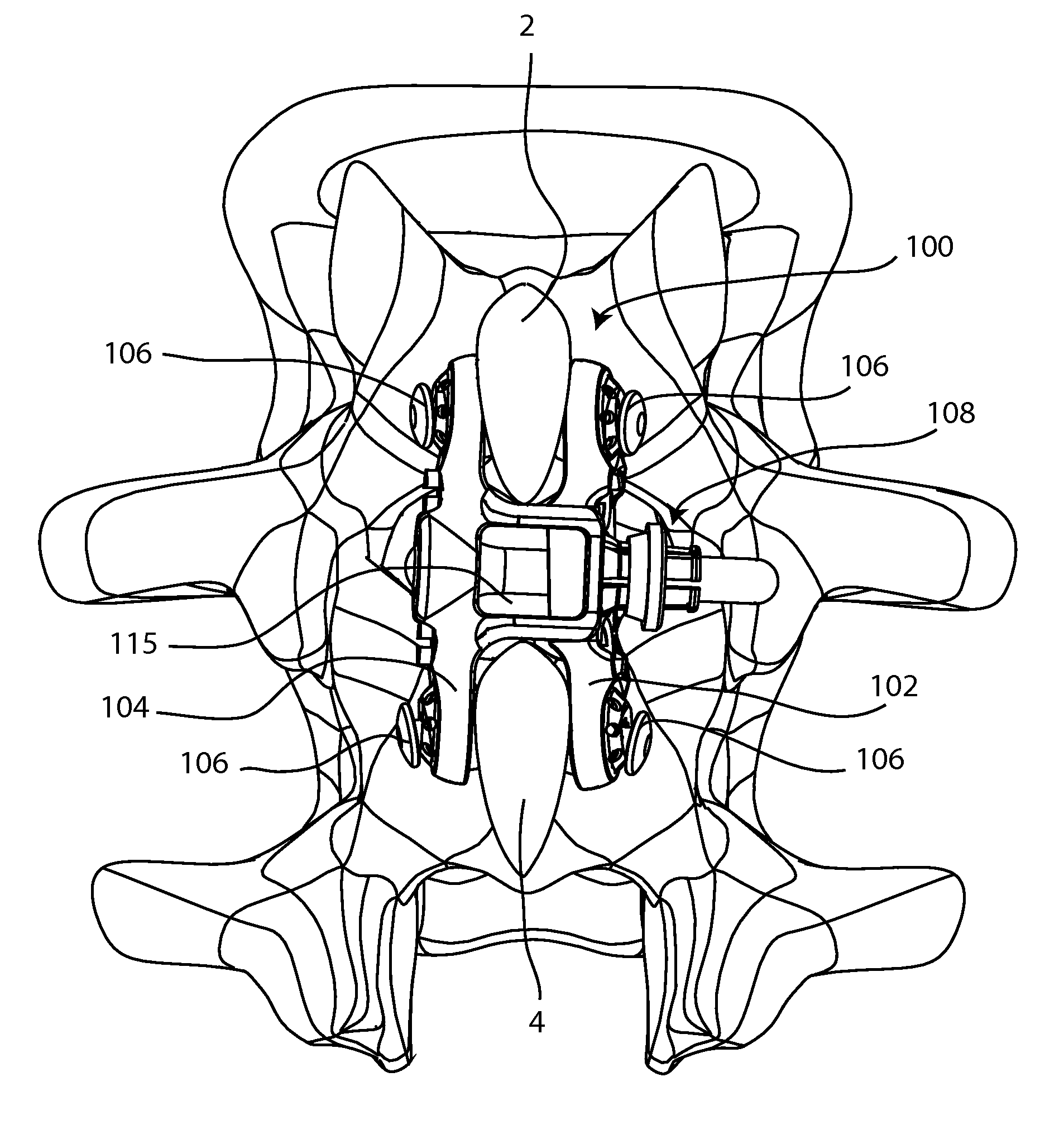 Spinous process fusion implants and insertion, compression, and locking instrumentation