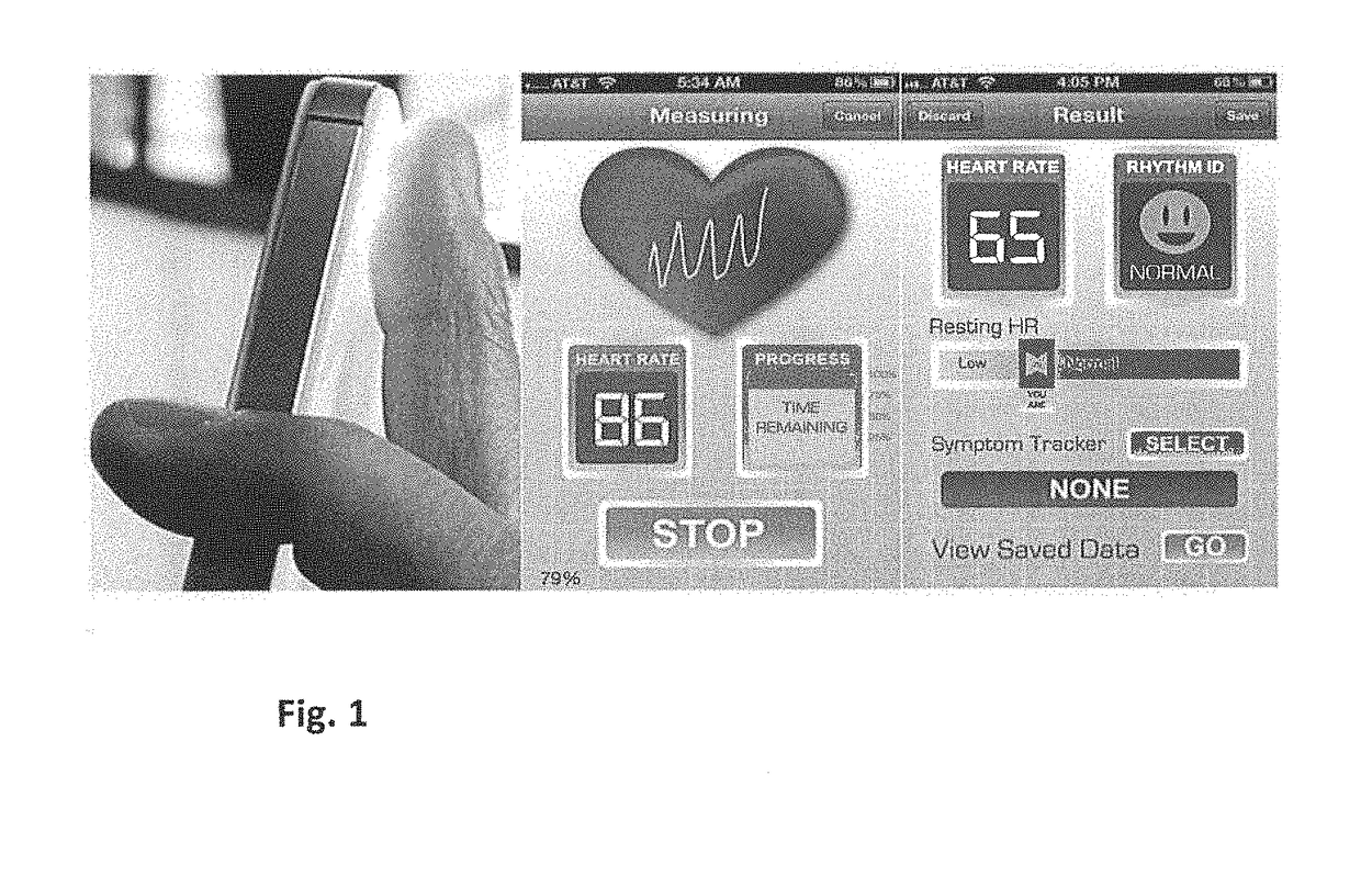 Detection and monitoring of atrial fibrillation