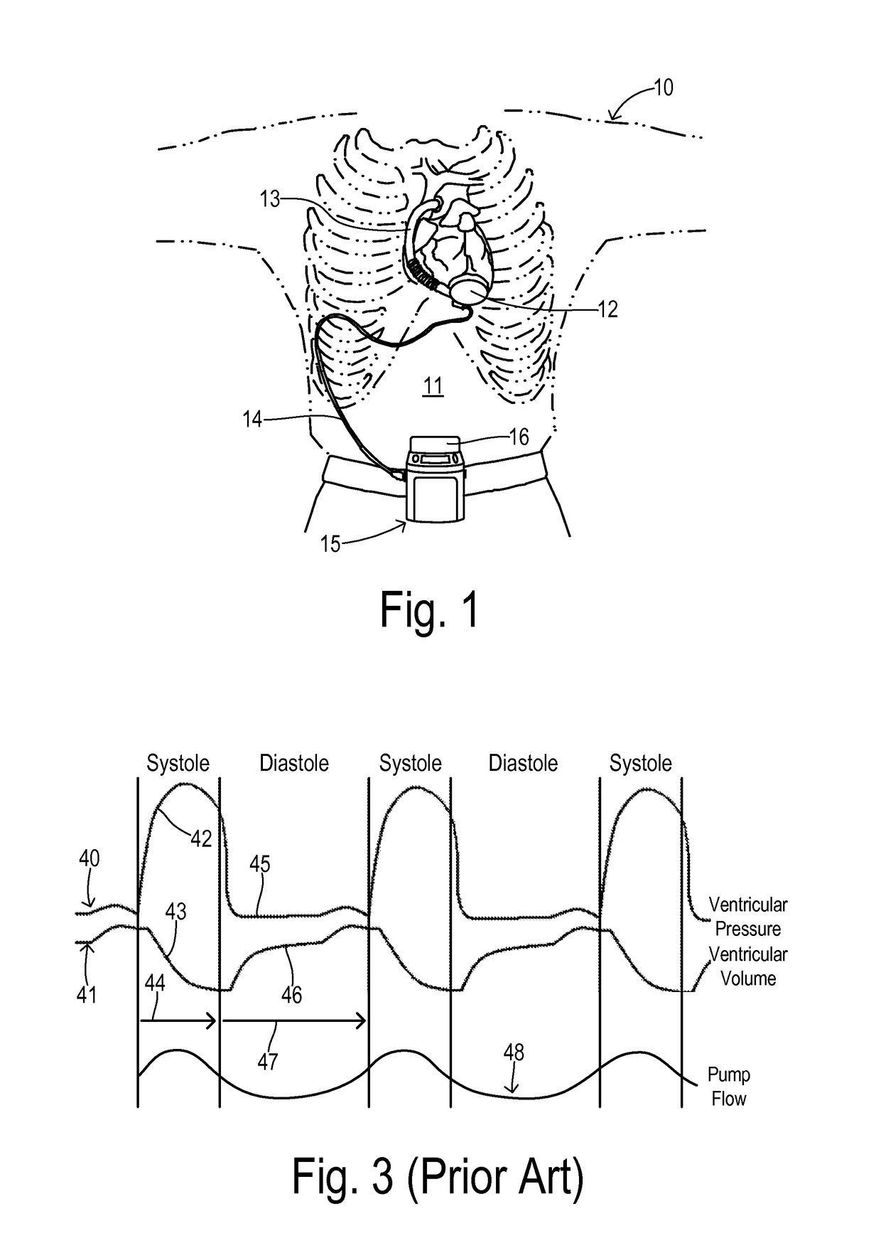 Cardiac pump with speed adapted for ventricle unloading