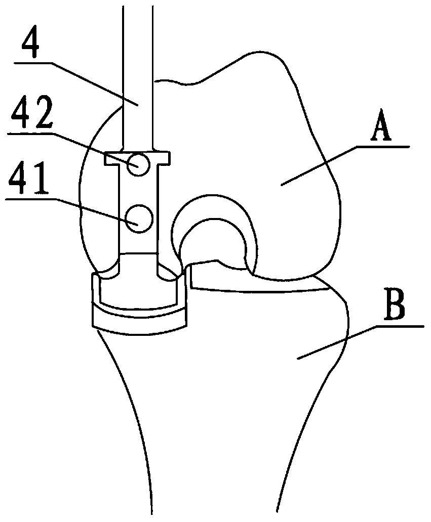 Femoral condyle measuring device used for unicompartmental knee arthroplasty