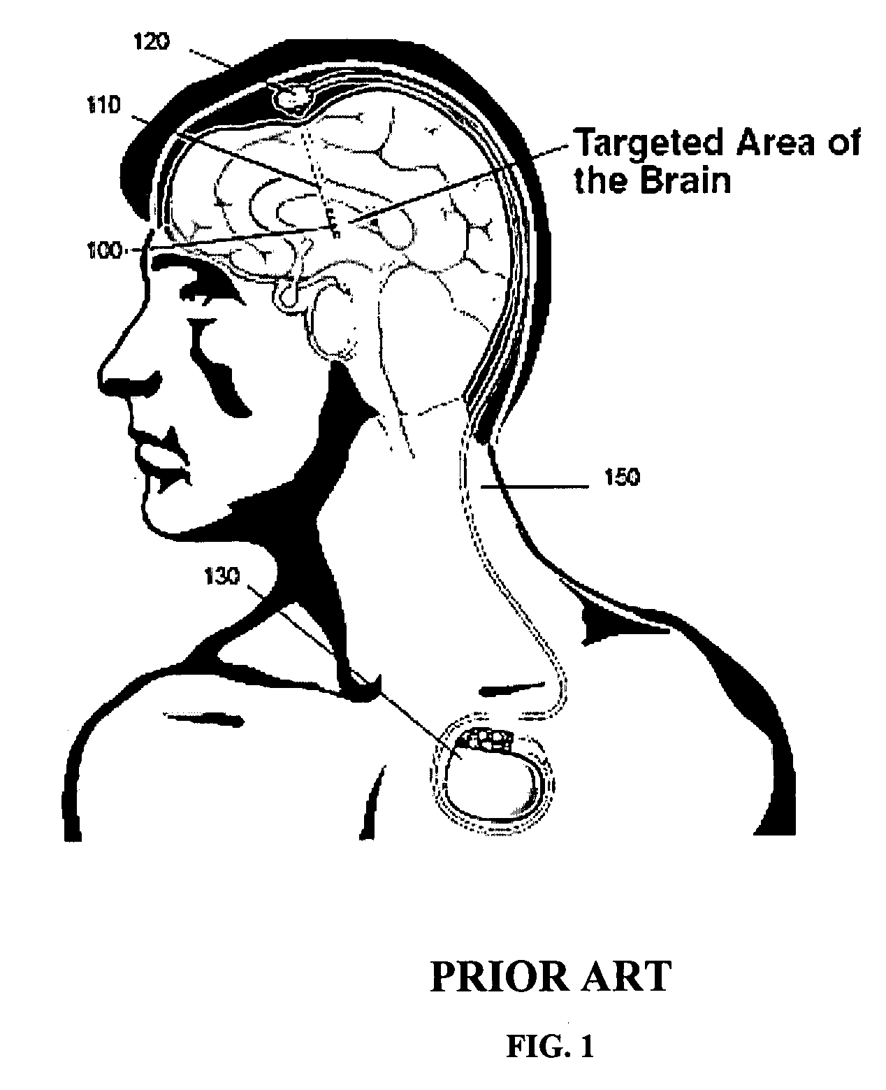 Device for multicentric brain modulation, repair and interface