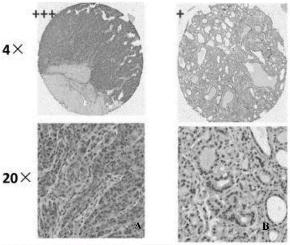 Application of reagents for detecting ccl15 chemokines in preparation of reagents for screening thyroid follicular carcinoma