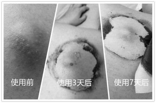 Traditional Chinese medicine composition for treating abscess and furuncle, and preparation method and application of traditional Chinese medicine composition