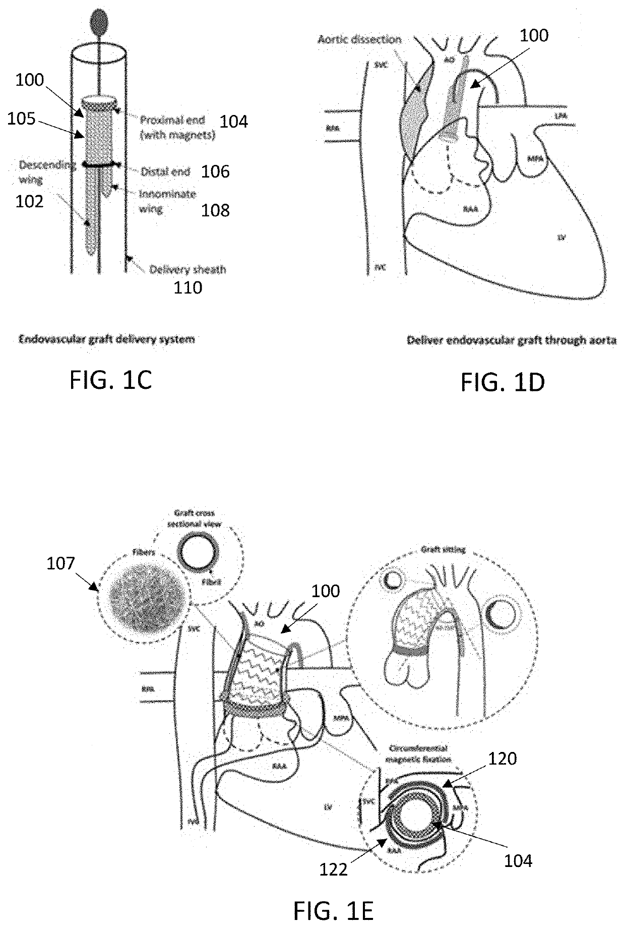 Transcatheter device, system and method for treating type a aortic dissection