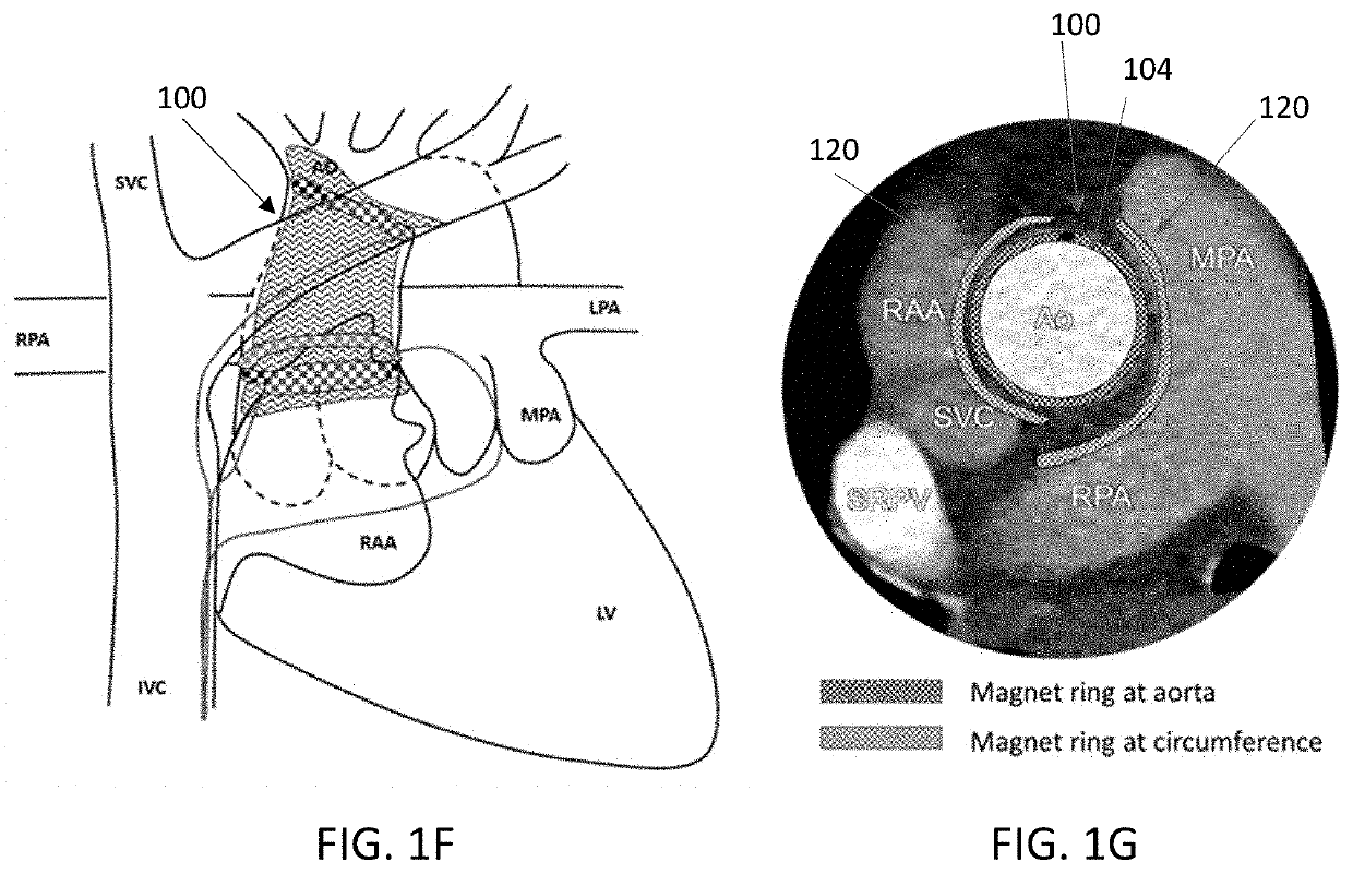 Transcatheter device, system and method for treating type a aortic dissection
