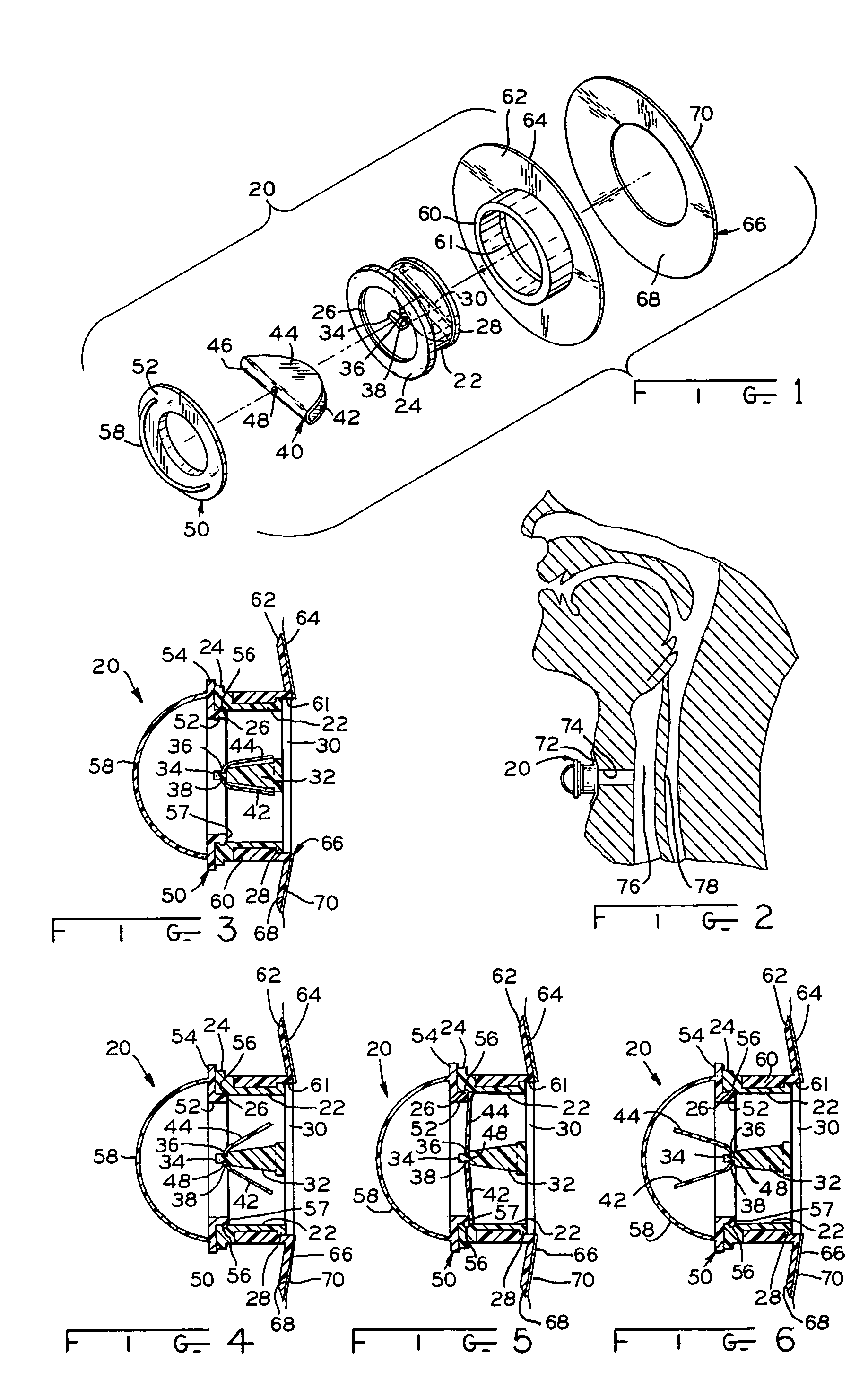 Method and apparatus for a tracheal valve