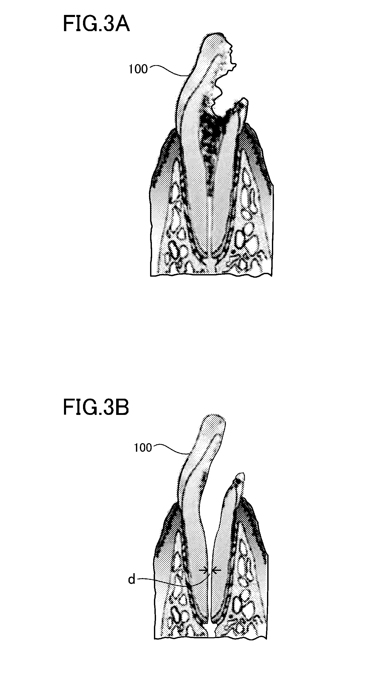 Unextracted tooth root canal filler and dental tissue regeneration method for unextracted tooth