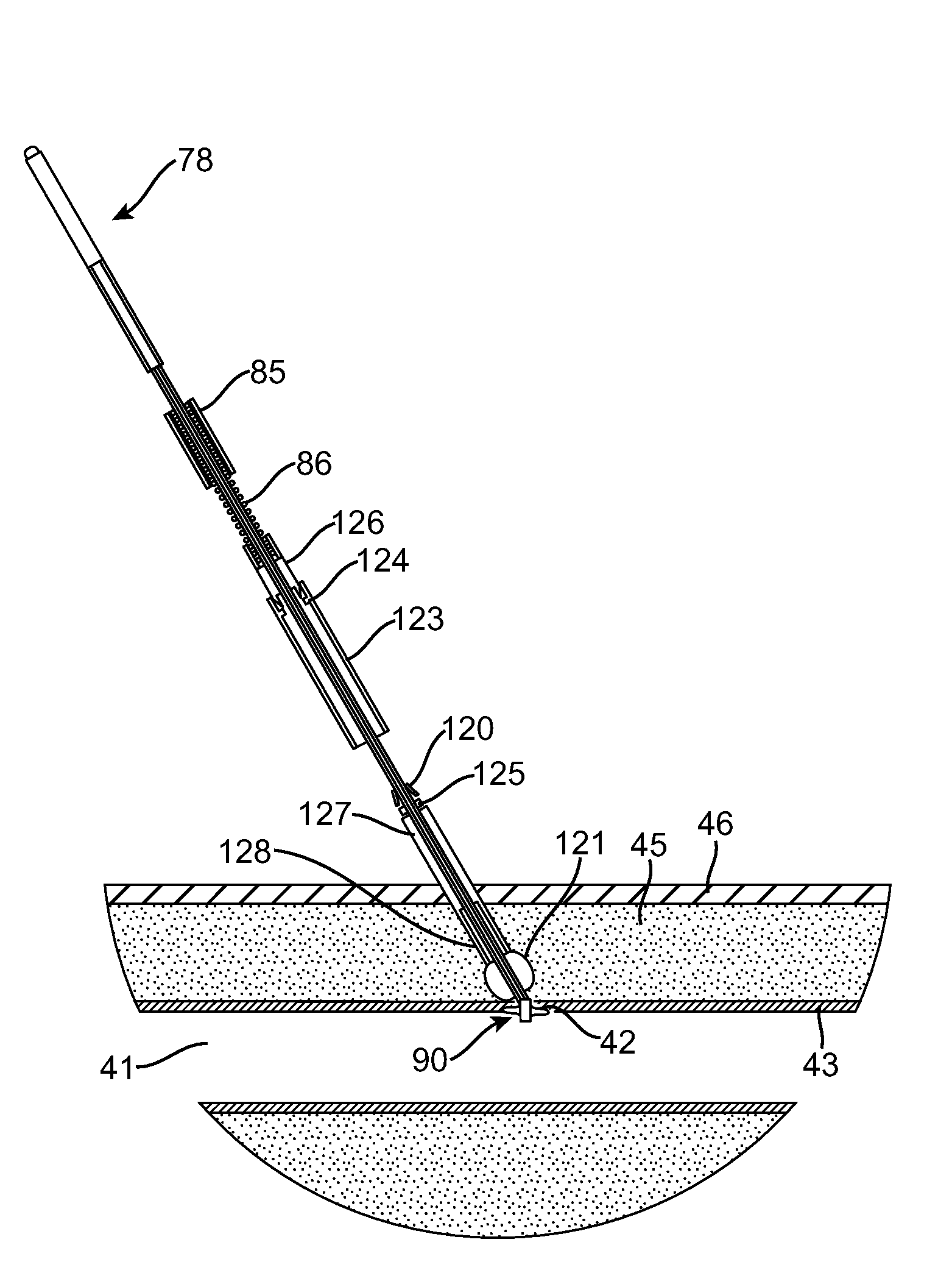 Apparatus and methods for delivering hemostatic materials for blood vessel closure