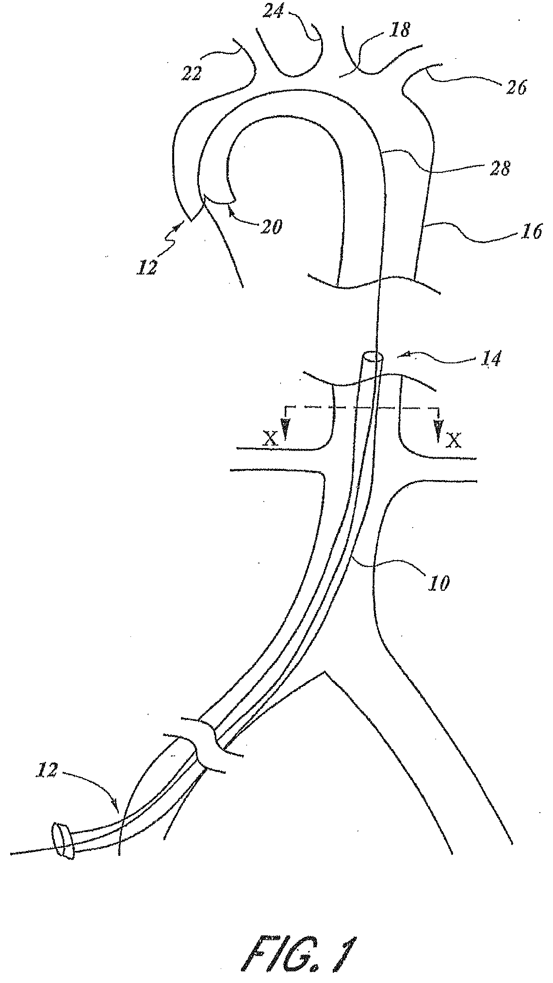 Embolic protection and access system