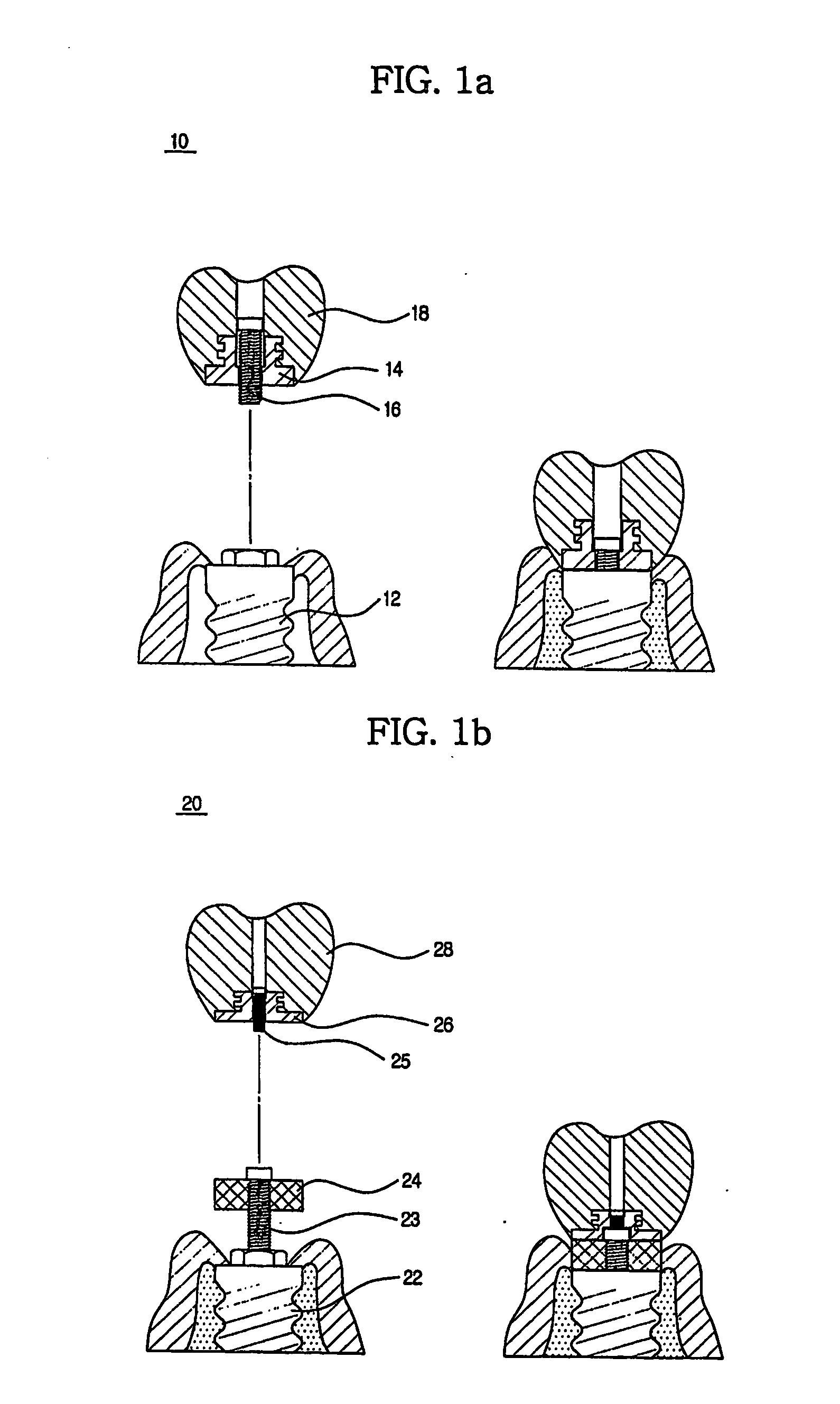 Method for treating a screw-cement retained prosthesis, abutment and implant for a screw-cement retained prosthesis