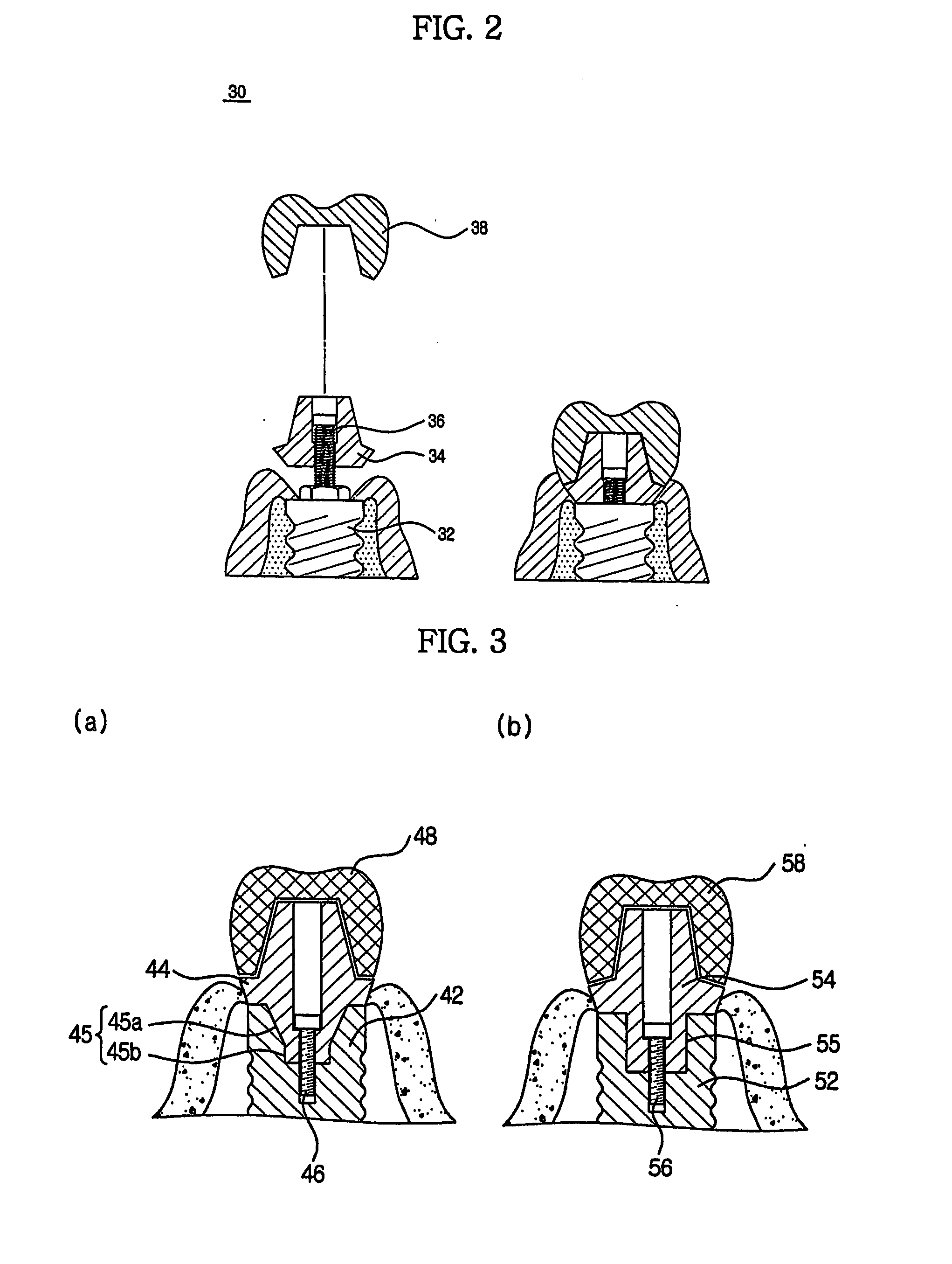 Method for treating a screw-cement retained prosthesis, abutment and implant for a screw-cement retained prosthesis