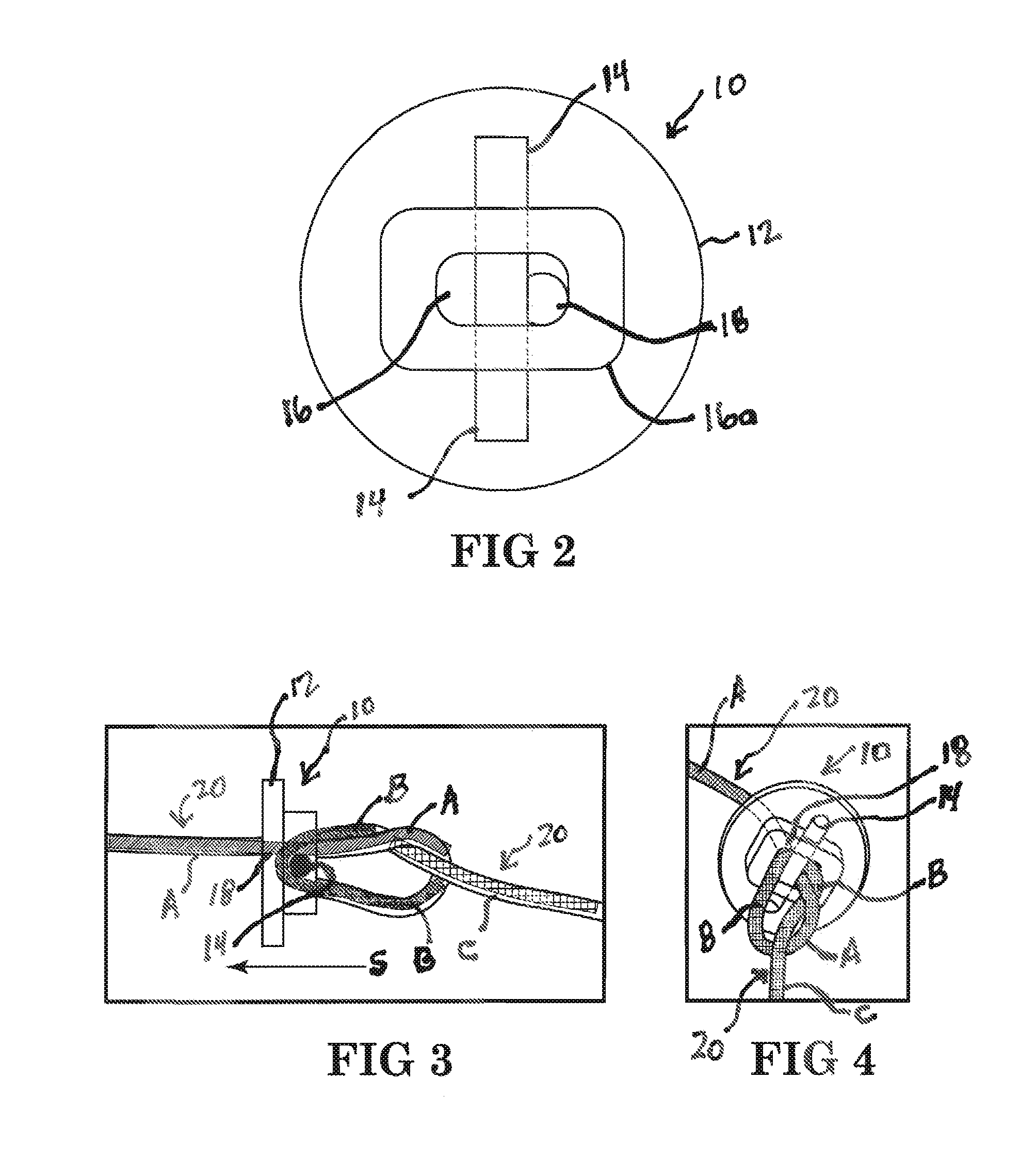 Adjustable suture restriction system and method