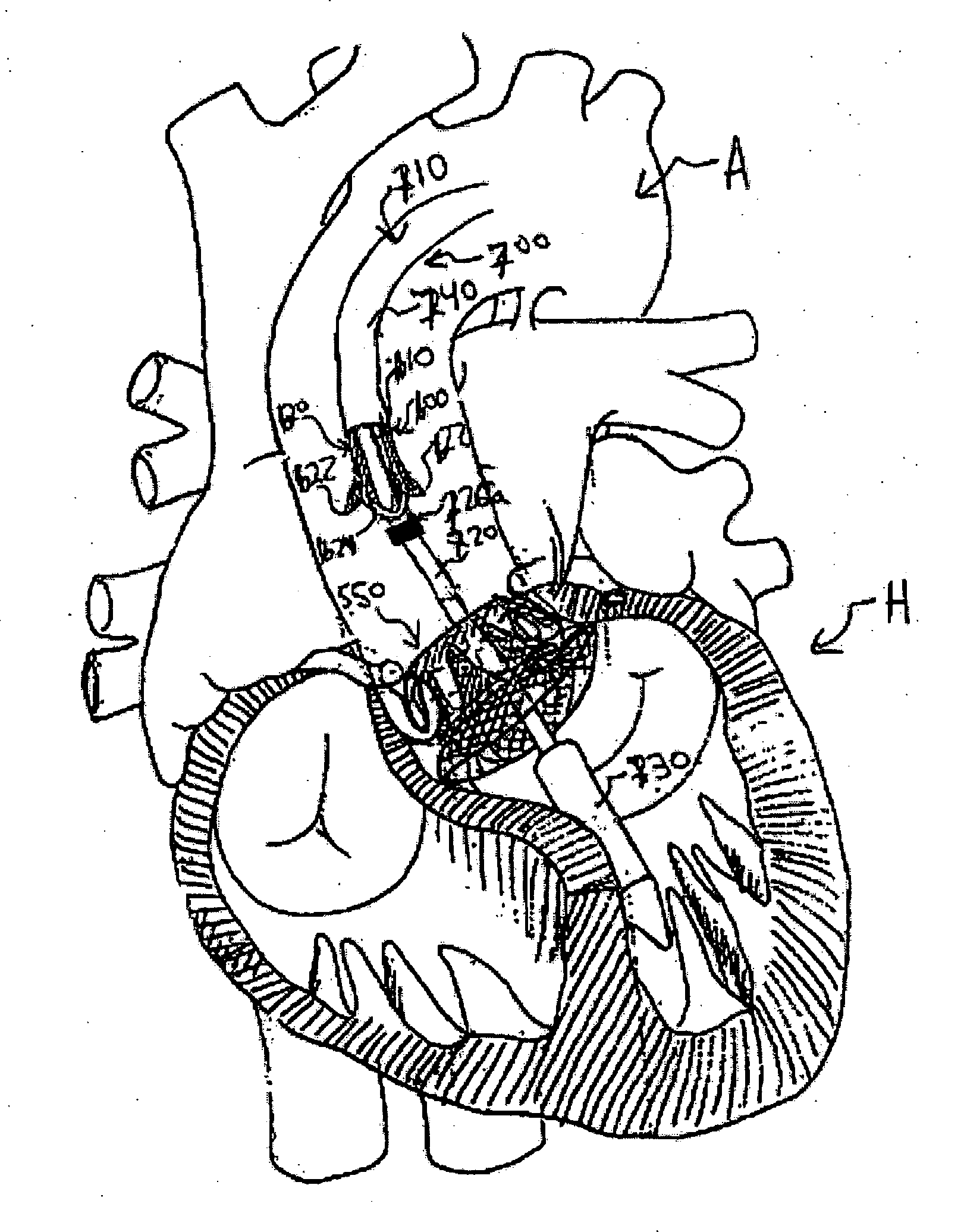 Two piece heart valve and anchor