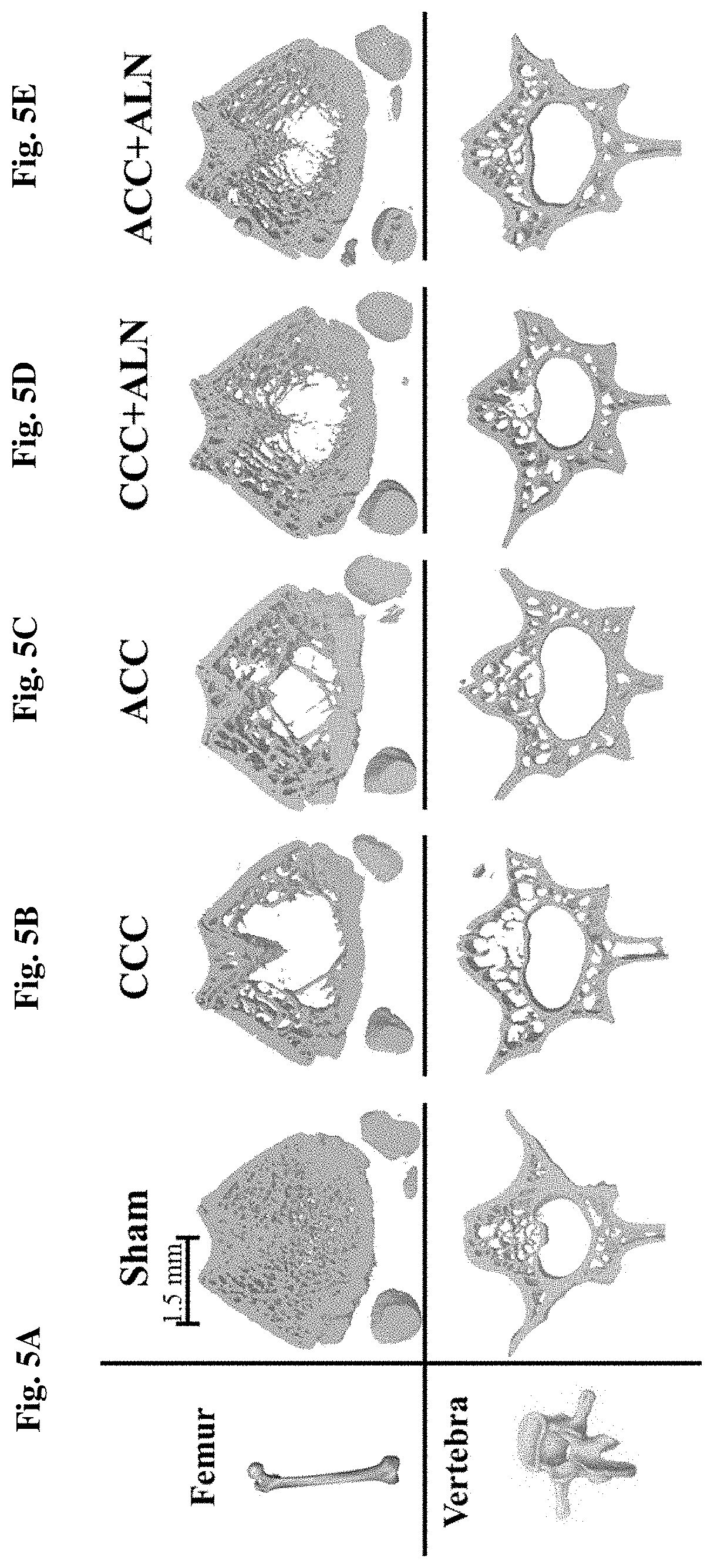 Amorphous calcium carbonate for the treatment of calcium malabsorption and metabolic bone disorders