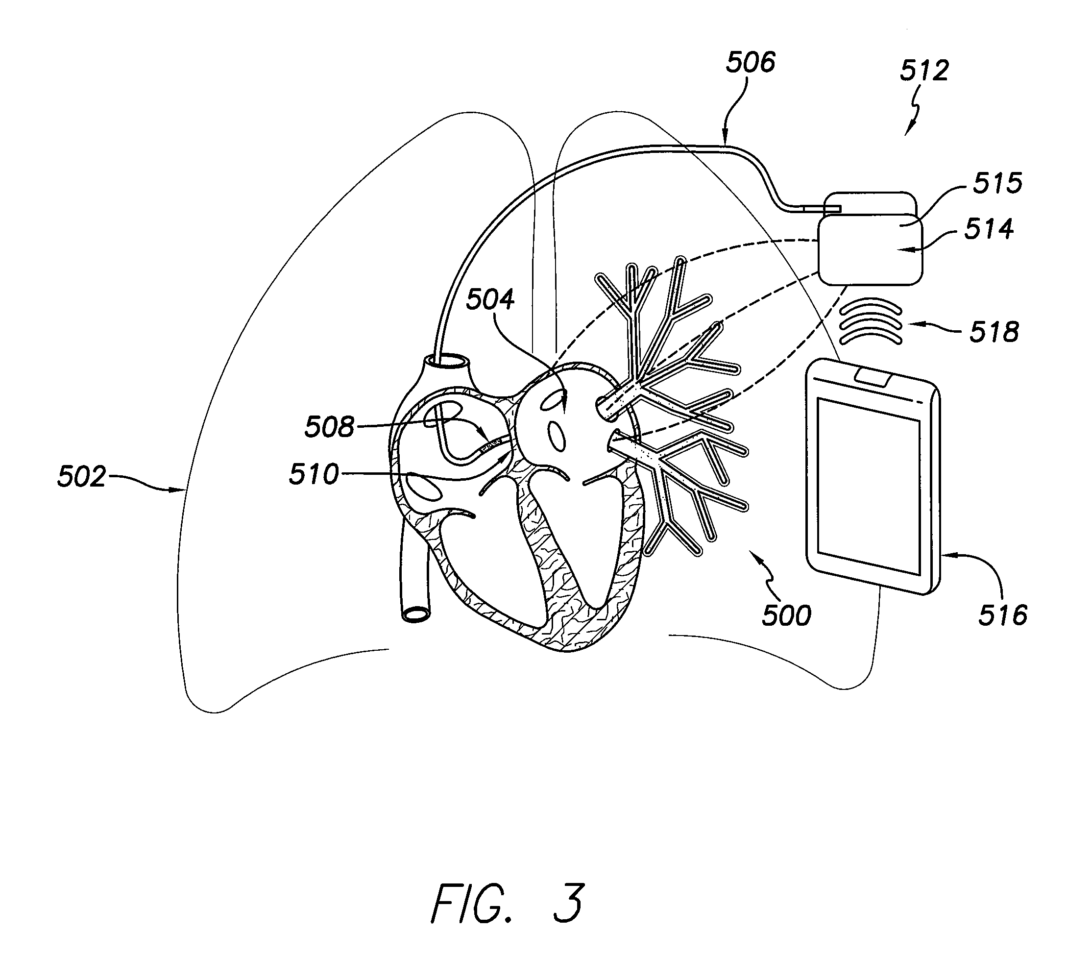 System and method for detecting and treating cardiovascular disease