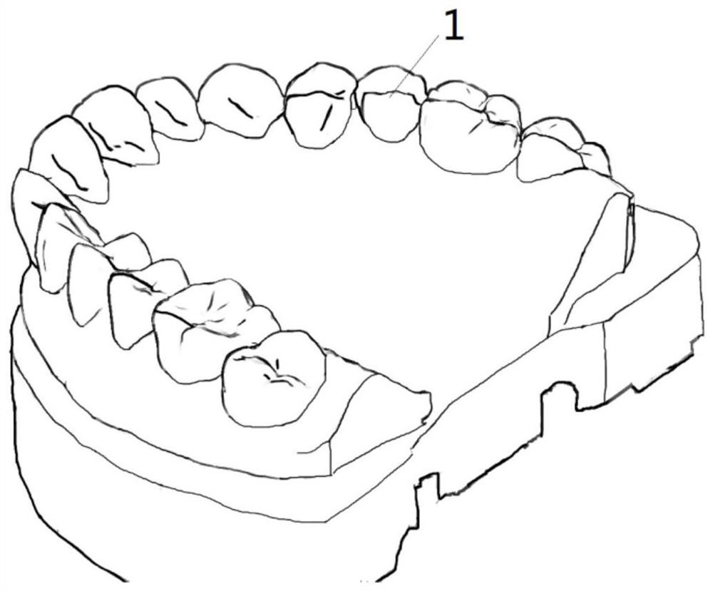 A digital metal gingival wall lifting guide plate and its manufacturing method