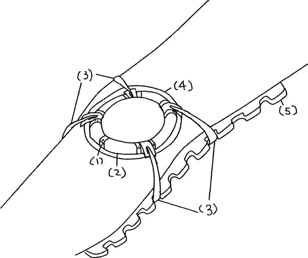 Patella fracture fixing device
