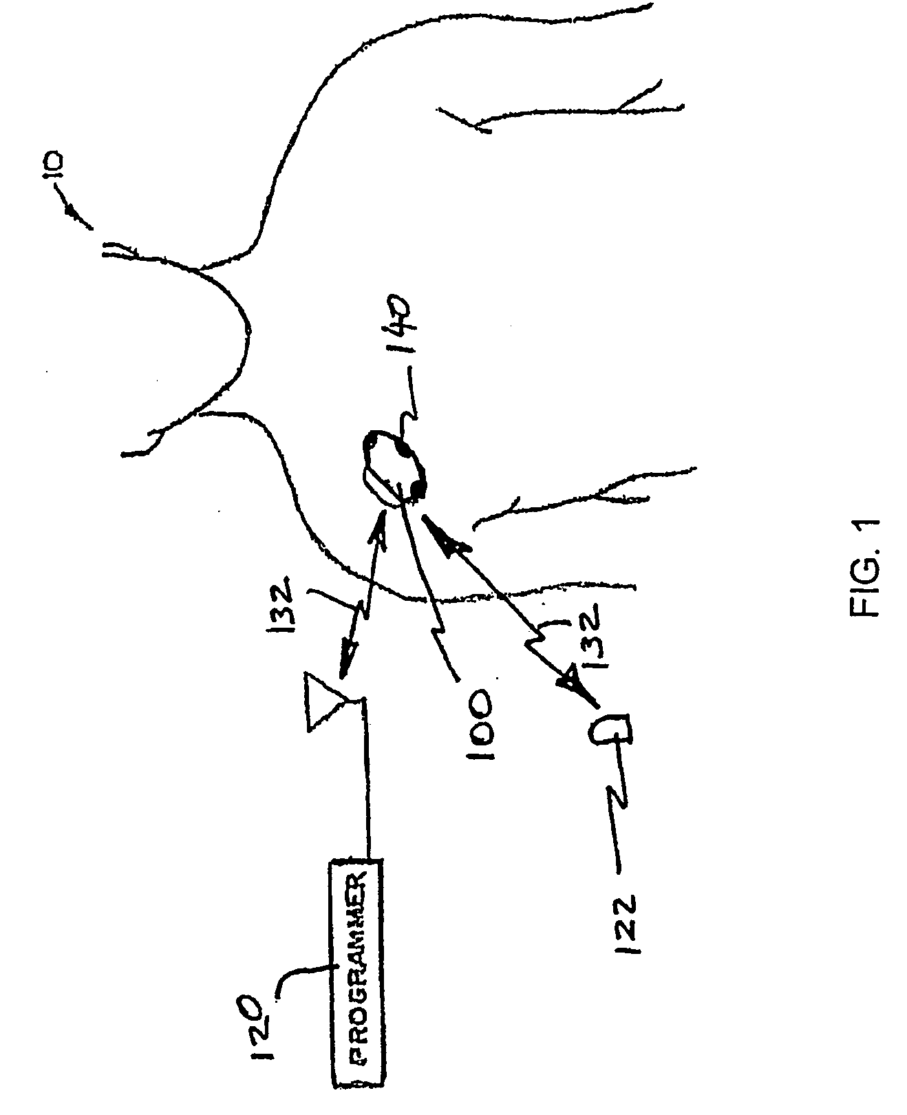 Apparatus for data retention in an implantable medical device