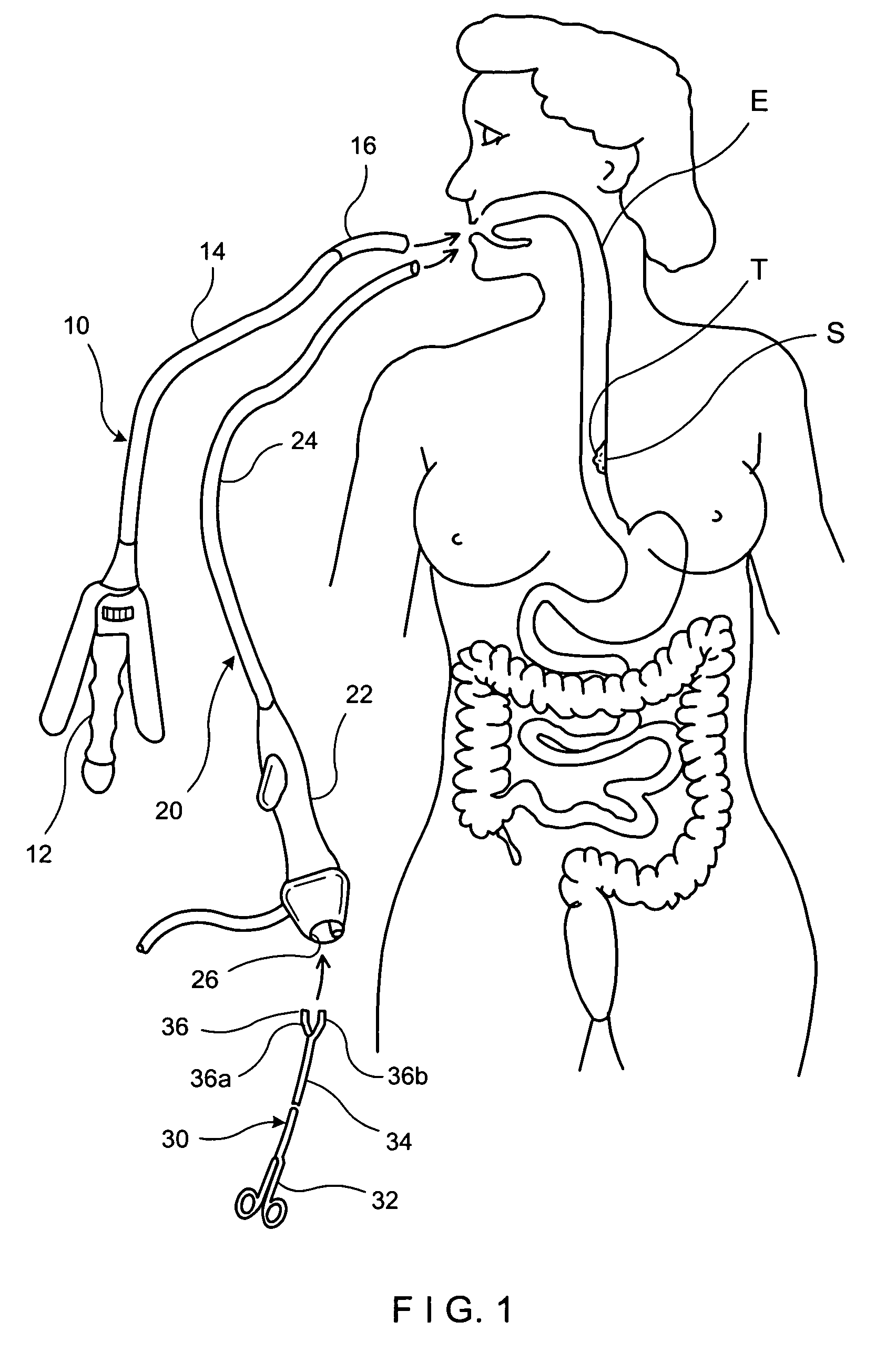 Apparatus and method for resectioning gastro-esophageal tissue