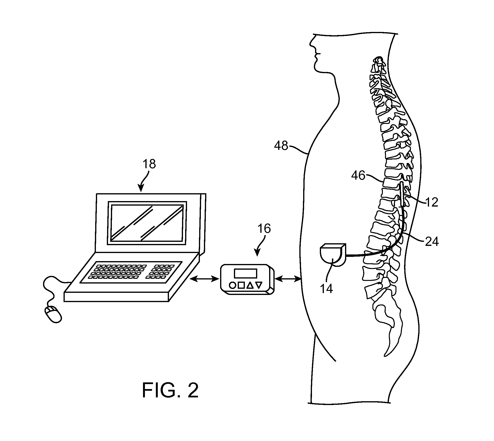 Neuromodulation using modulated pulse train