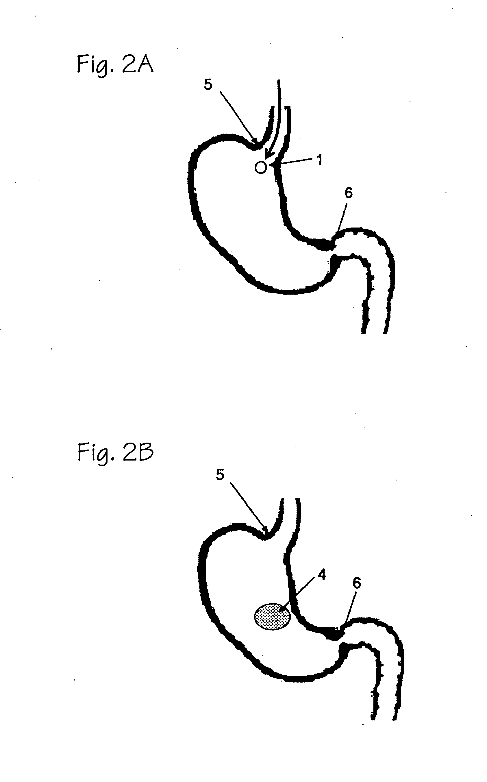 Ingestible formulations for transient, noninvasive reduction of gastric volume