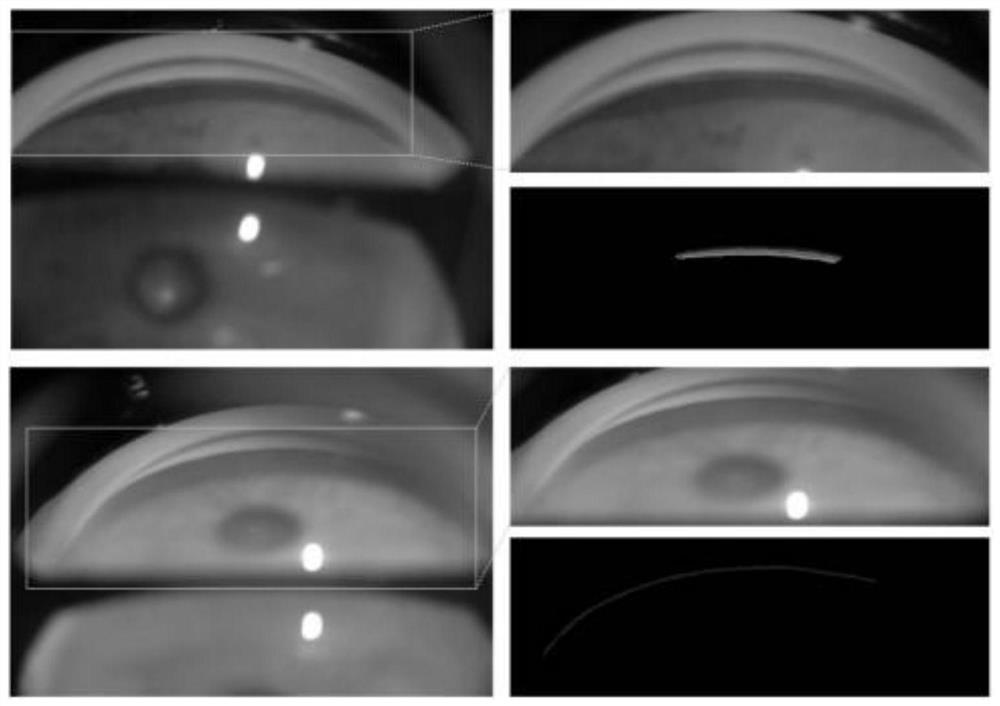 Anterior chamber angle image grading method fused with weak supervision metric learning