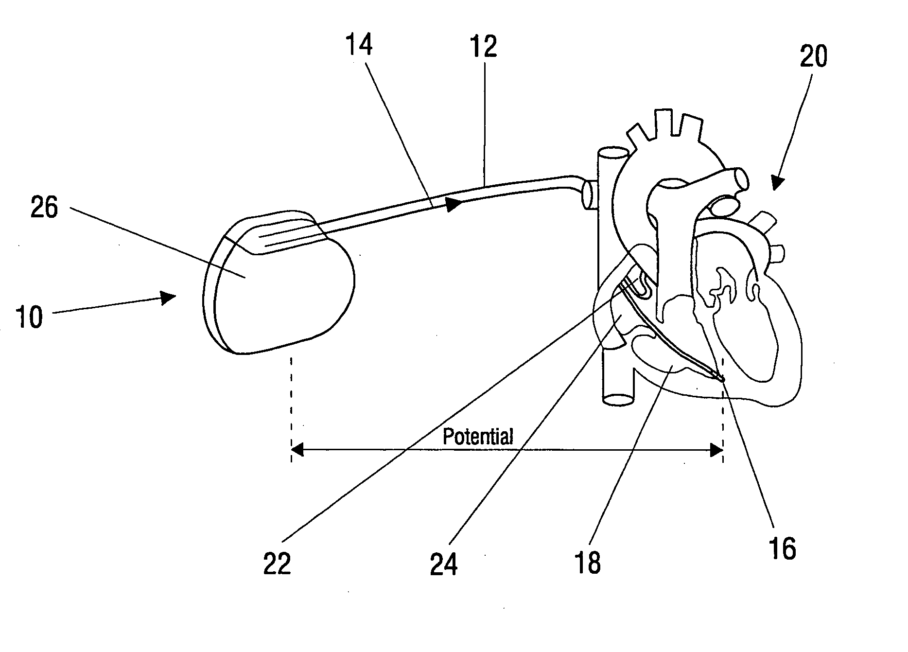 Electrotherapy device