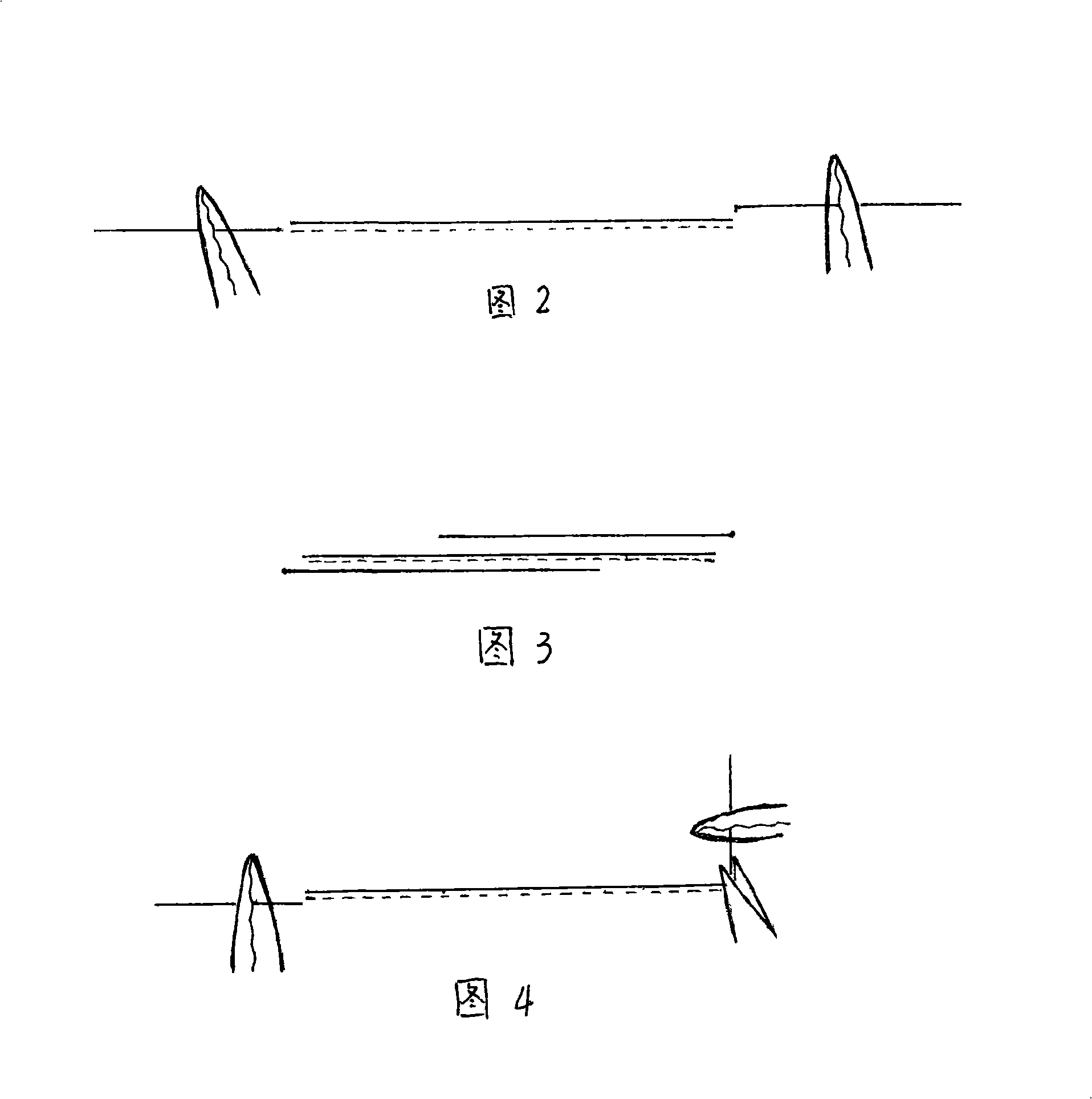 Beauty treatment suturing method for operation incision and traumatism wound