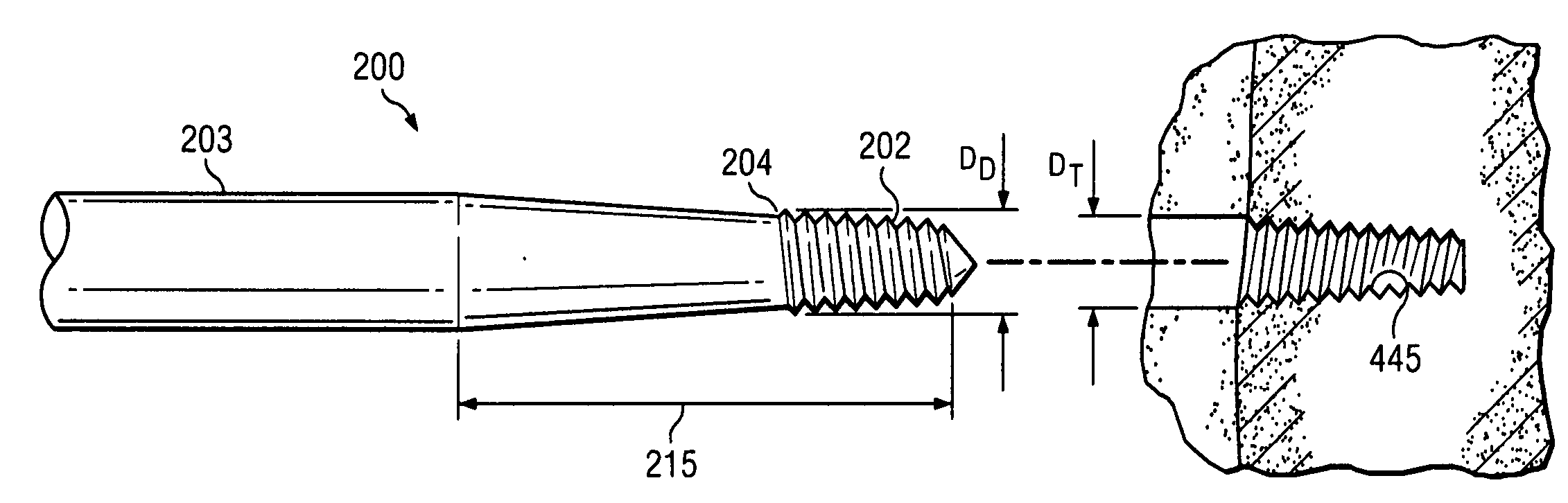 Engaging predetermined radial preloads in securing an orthopedic fastener